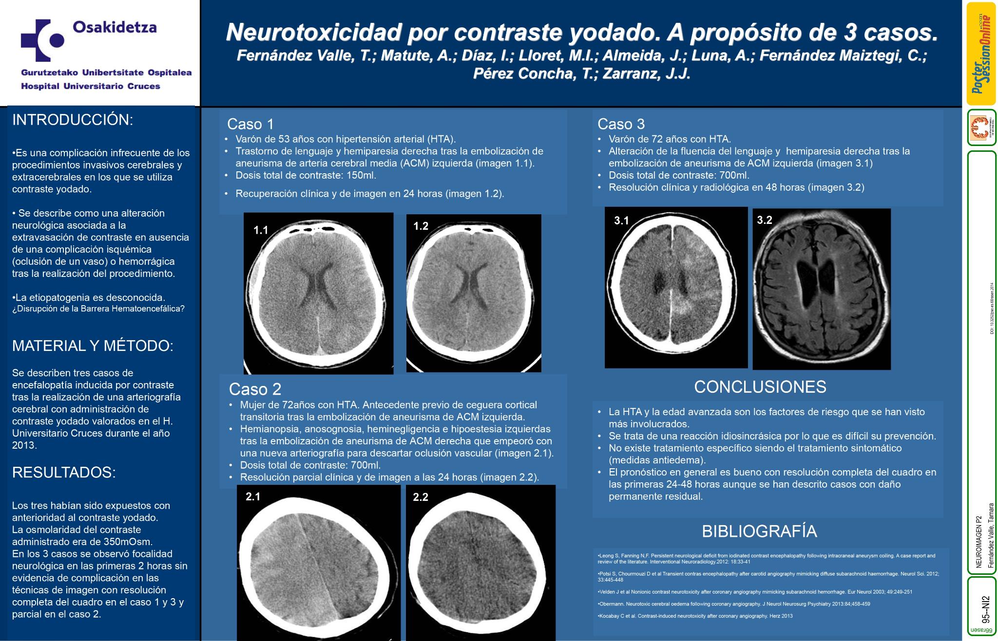Neurotoxicidad por contraste yodado. A proposito de 3 casos