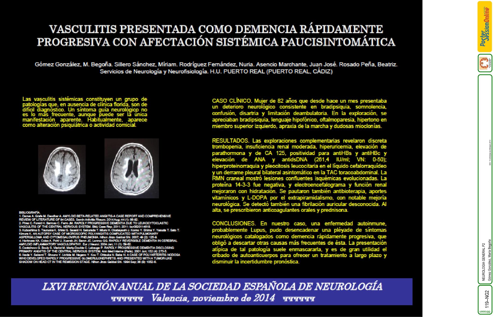 Vasculitis de presentación como demenciación rápidamente progresiva con afectación sistémica paucisintomática