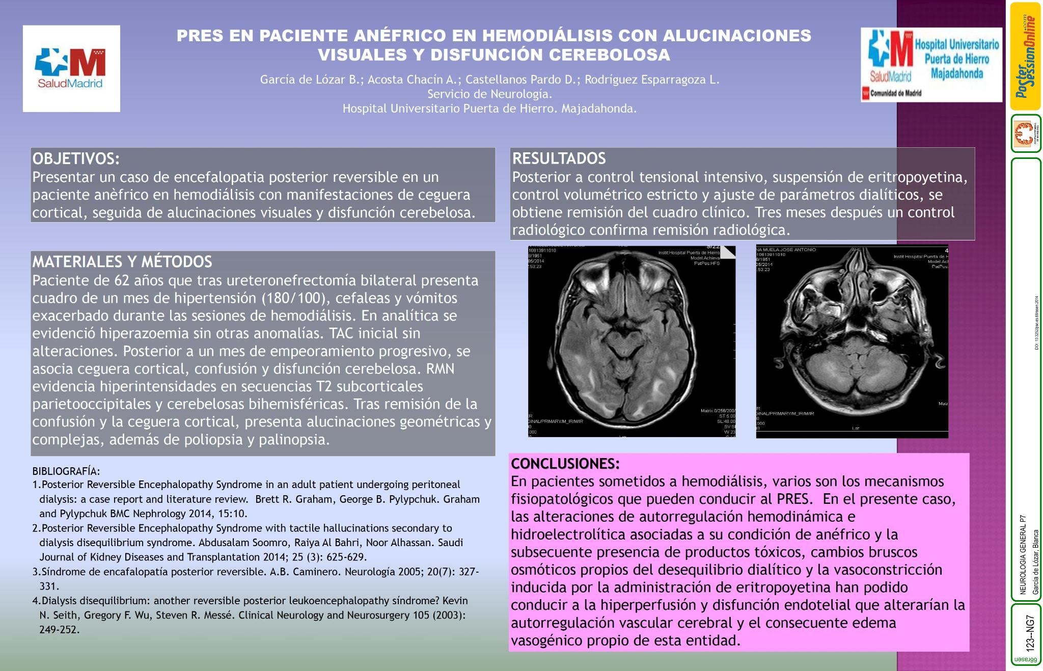 PRES en paciente anéfrico en hemodiálisis con alucinaciones visuales y disfunción cerebelosa