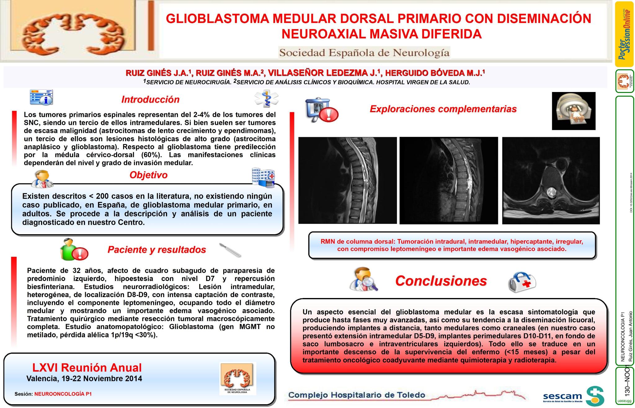 Glioblastoma medular dorsal primario con diseminación neuroaxial masiva diferida