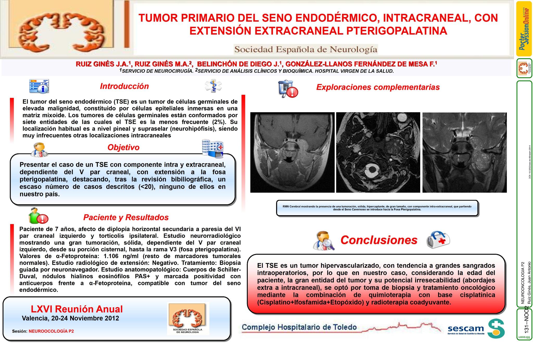 Tumor primario del seno endodérmico, intracraneal, con extensión extracraneal pterigopalatina