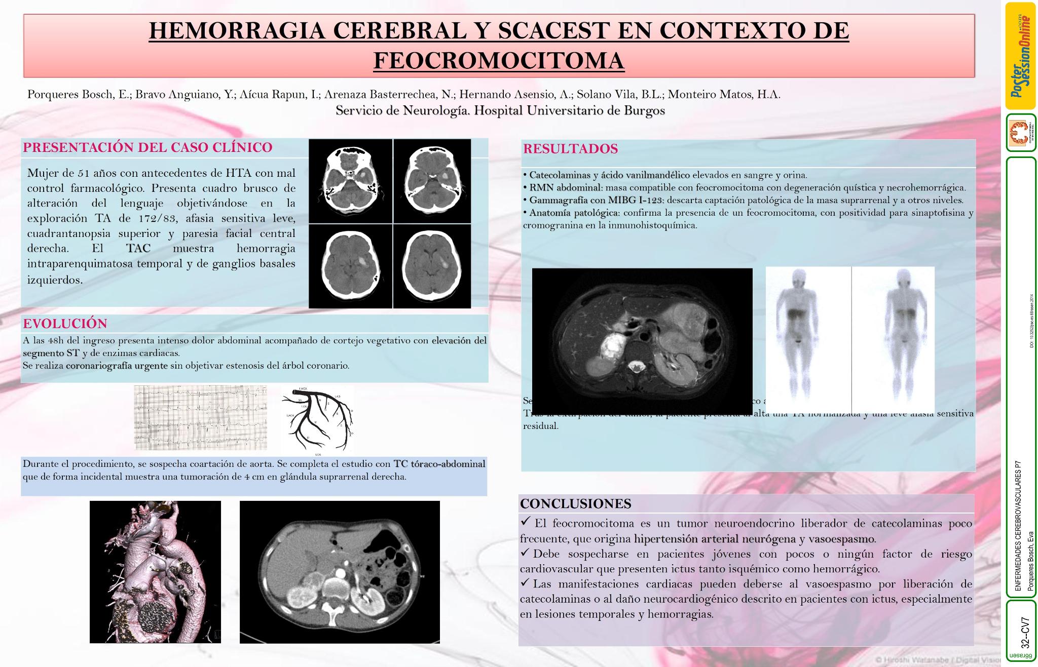 Hemorragia cerebral y SCACEST en contexto de feocromocitoma