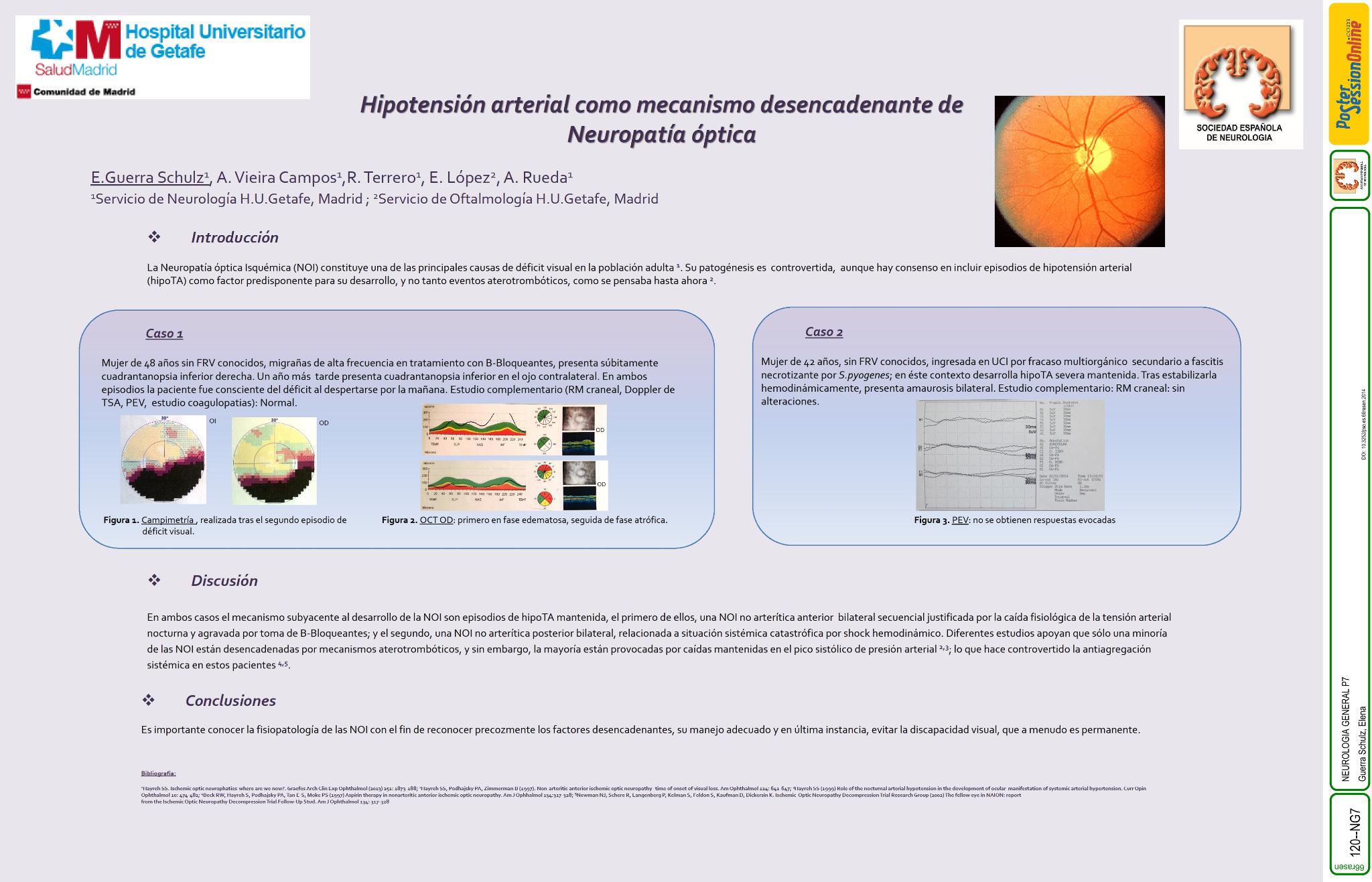 Hipotensión arterial como mecanismo desencadenante de Neuropatía óptica