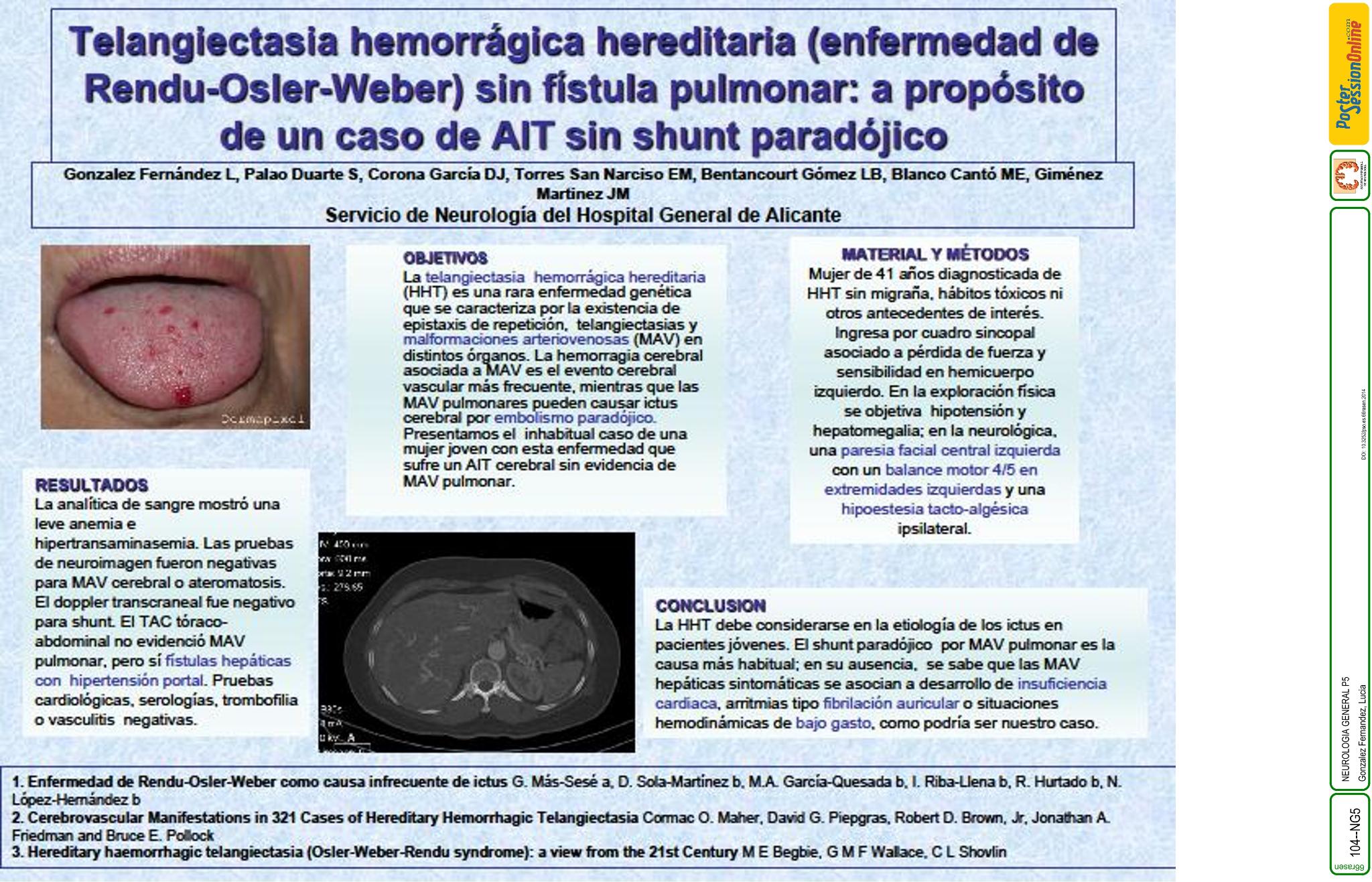 Telangiectasia hemorrágica hereditaria (enfermedad de Rendu-Osler-Weber) sin fístula pulmonar: a propósito de un caso de ictus sin shunt paradójico