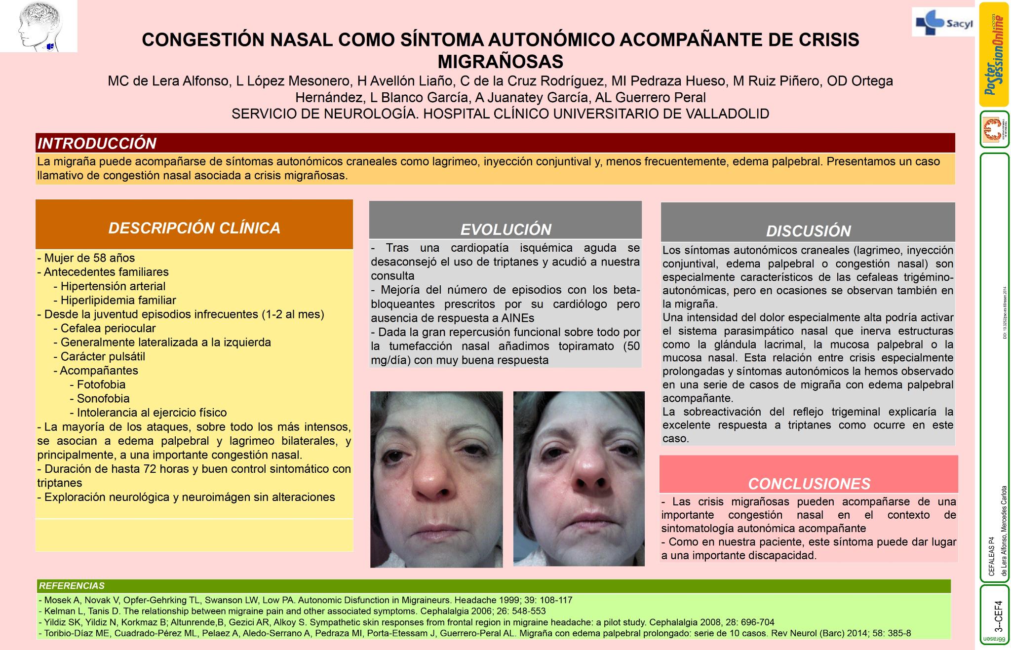 Congestión nasal como síntoma autonómico acompañante de crisis migrañosas
