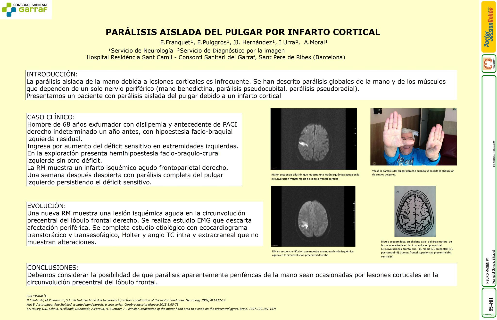 Parálisis aislada del pulgar por infarto cortical