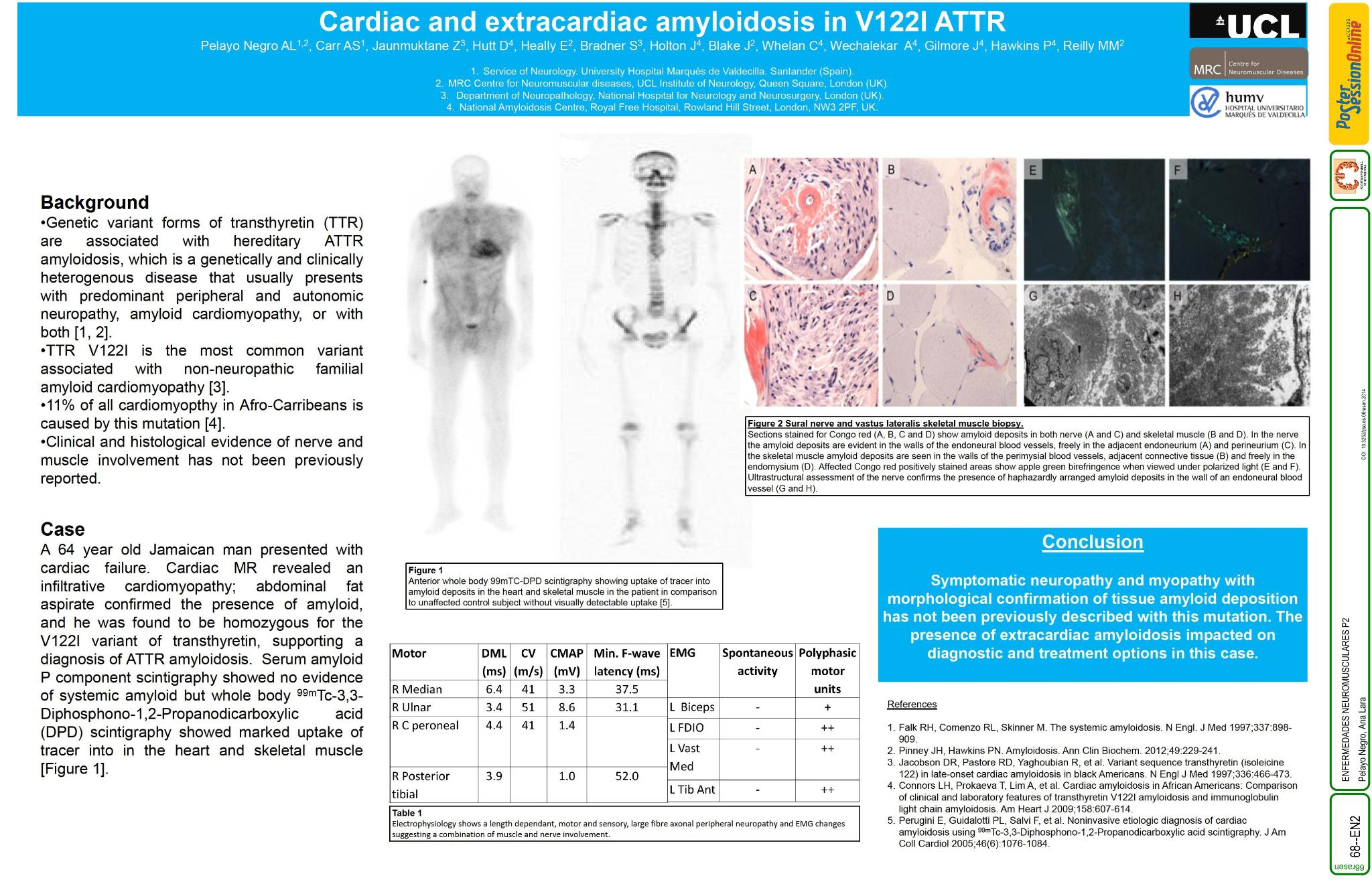 Amiloidosis cardiaca y extracardiaca en un paciente con mutacion V122I en el gen de la transtiretina