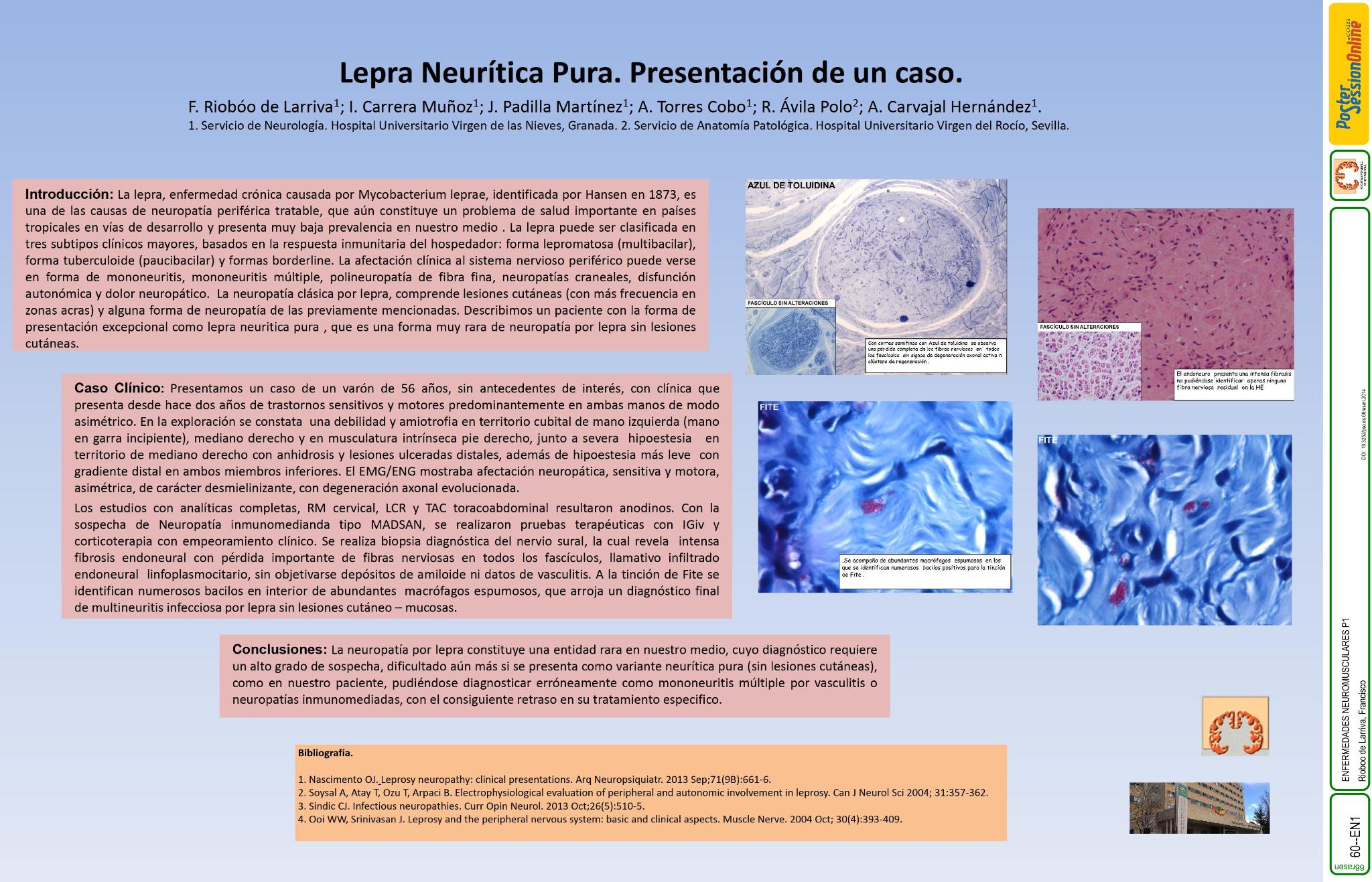 Lepra Neurítica Pura. Presentación de un caso