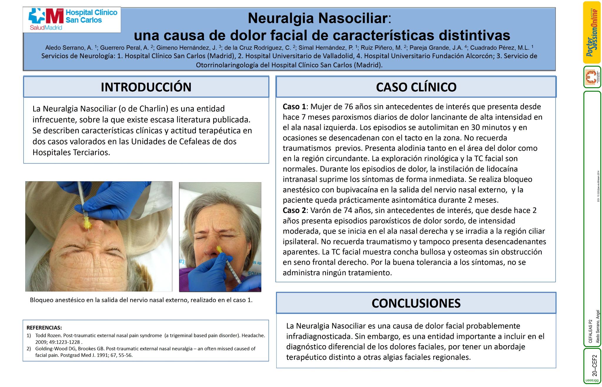 Neuralgia Nasociliar: una causa de dolor facial de características distintivas