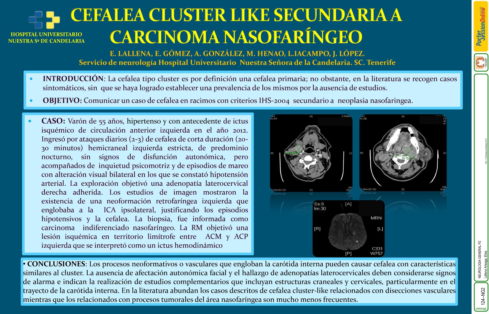 Cefalea cluster like secundaria a carcinoma nasofaríngeo