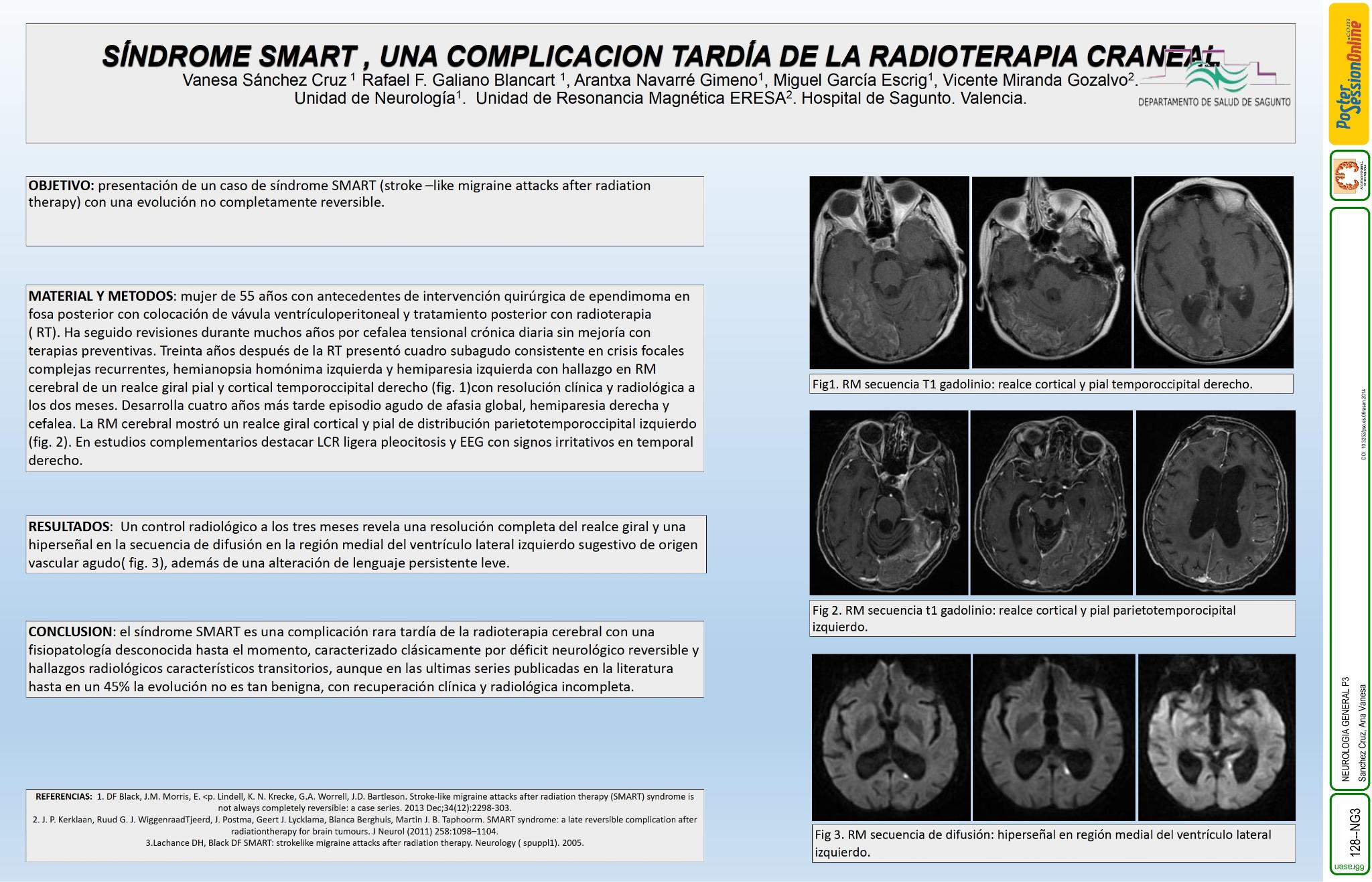 Síndrome SMART, una complicación tardía  de la radioterapia craneal