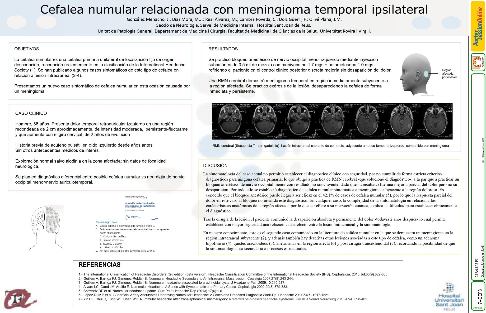 Cefalea numular relacionada con meningioma temporal ipsilateral