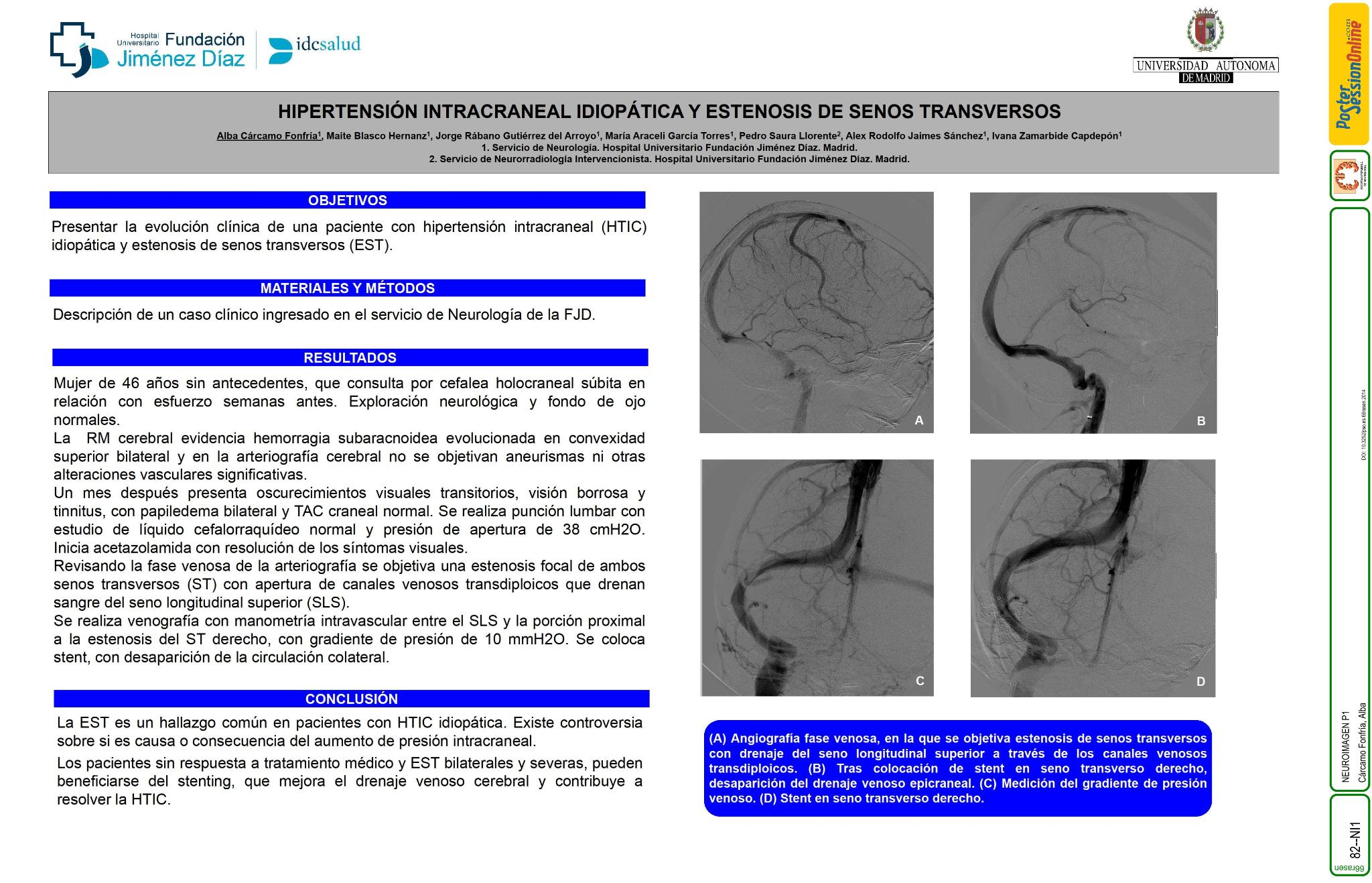 Hipertensión intracraneal idiopática y estenosis de senos transversos