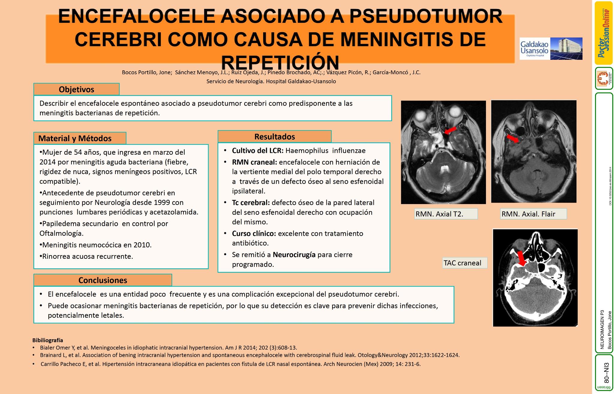Encefalocele asociado a pseudotumor cerebri como causa de meningitis de repetición