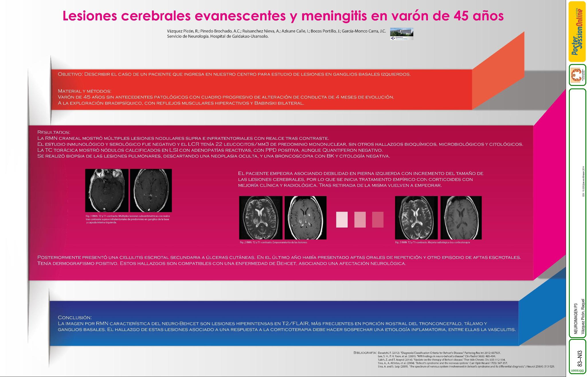 Lesiones cerebrales evanescentes y meningitis en varón de 45 años