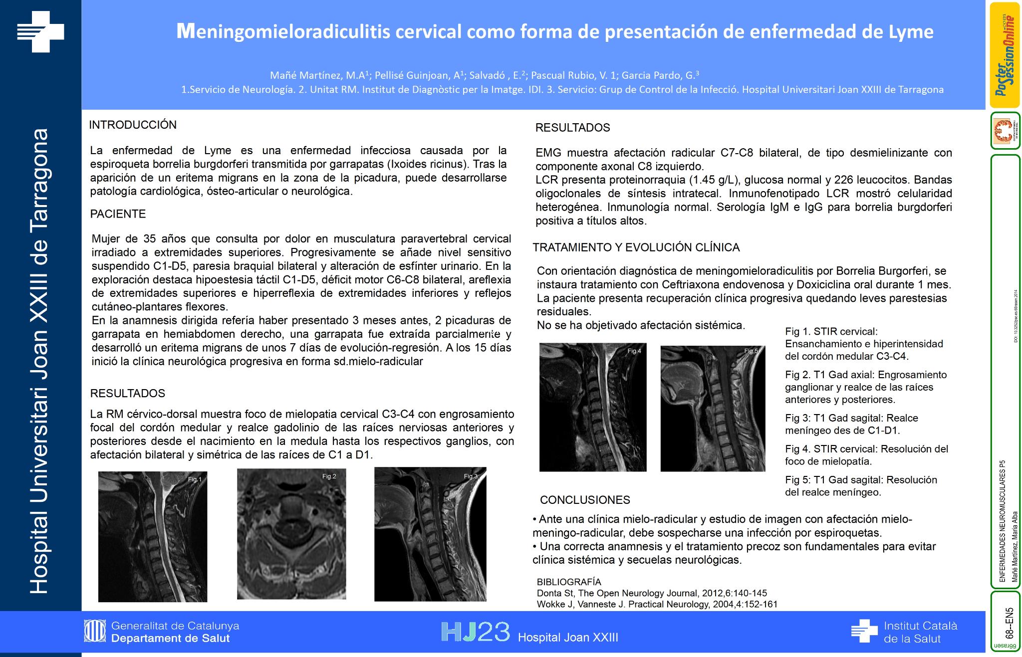 Meningomieloradiculitis cervical como forma de presentación de enfermeda de Lyme