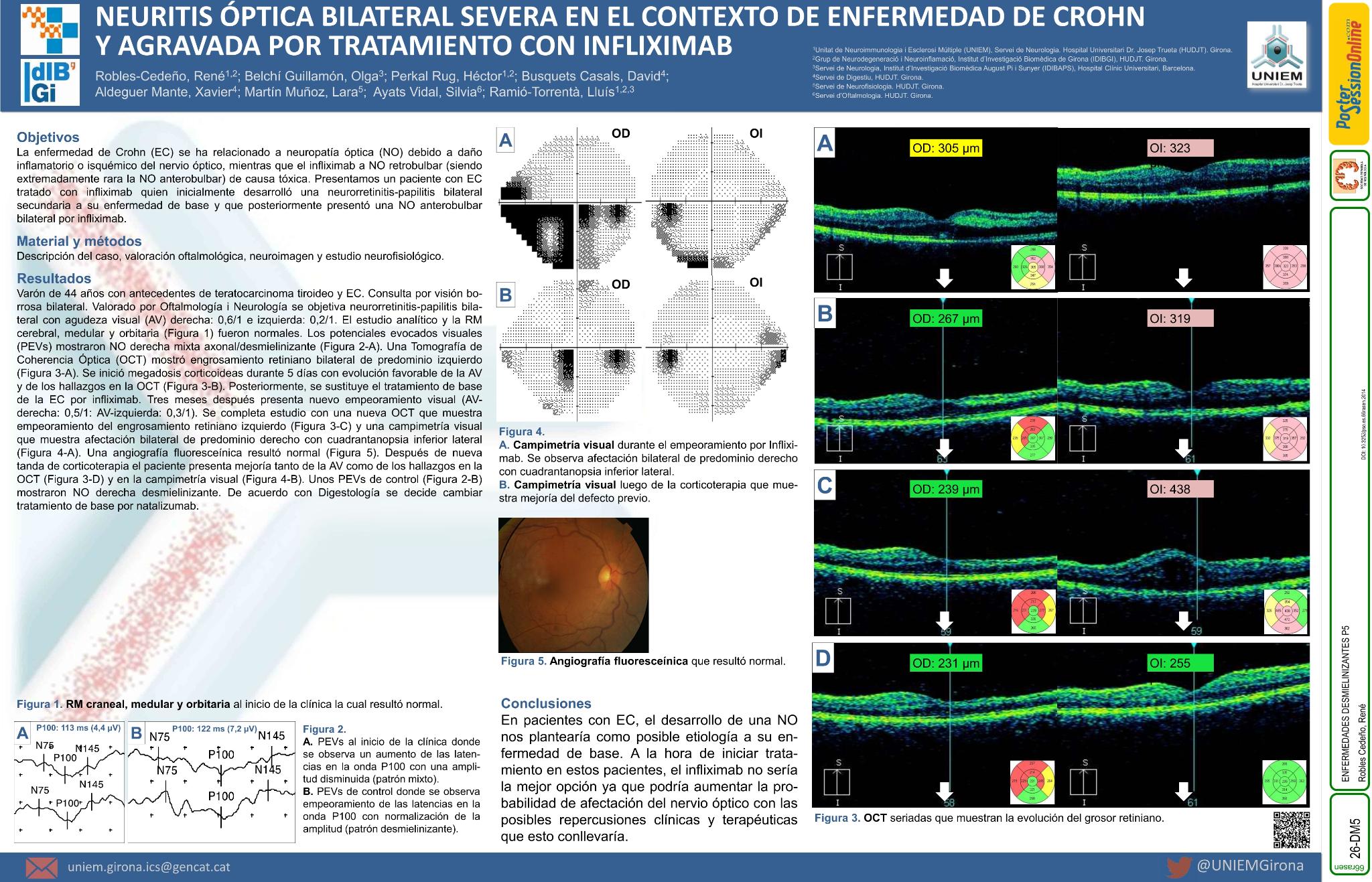 Neuritis óptica bilateral severa en el contexto de enfermedad de Crohn y agravada por tratamiento con infliximab
