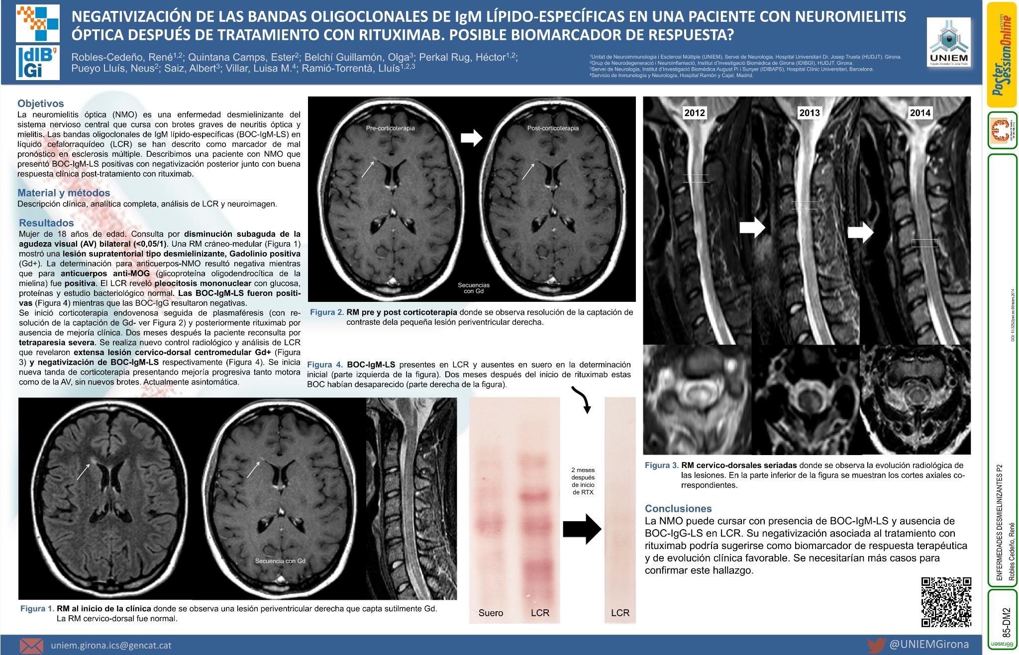 Negativización de las bandas oligoclonales de IgM lípido-específicas en una paciente con neuromielitis óptica después de tratamiento con rituximab. Posible biomarcador de respuesta?