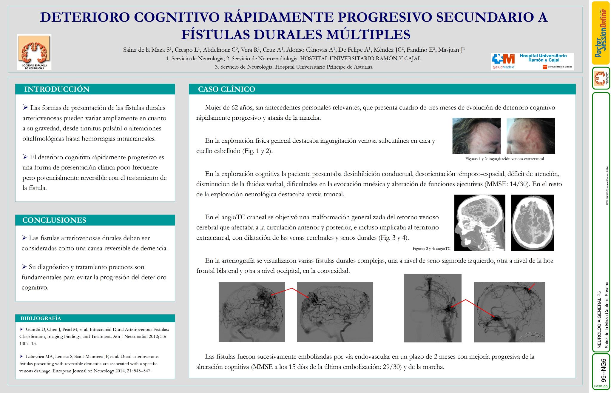 Deterioro cognitivo rápidamente progresivo secundario a fístulas durales múltiples