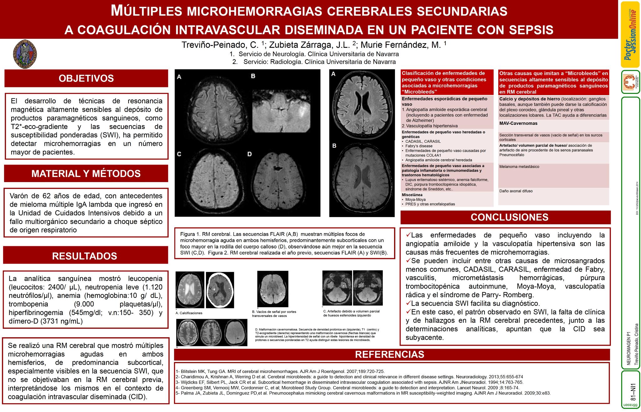 Múltiples microhemorragias cerebrales secundarias a coagulación intravascular diseminada en paciente con sepsis