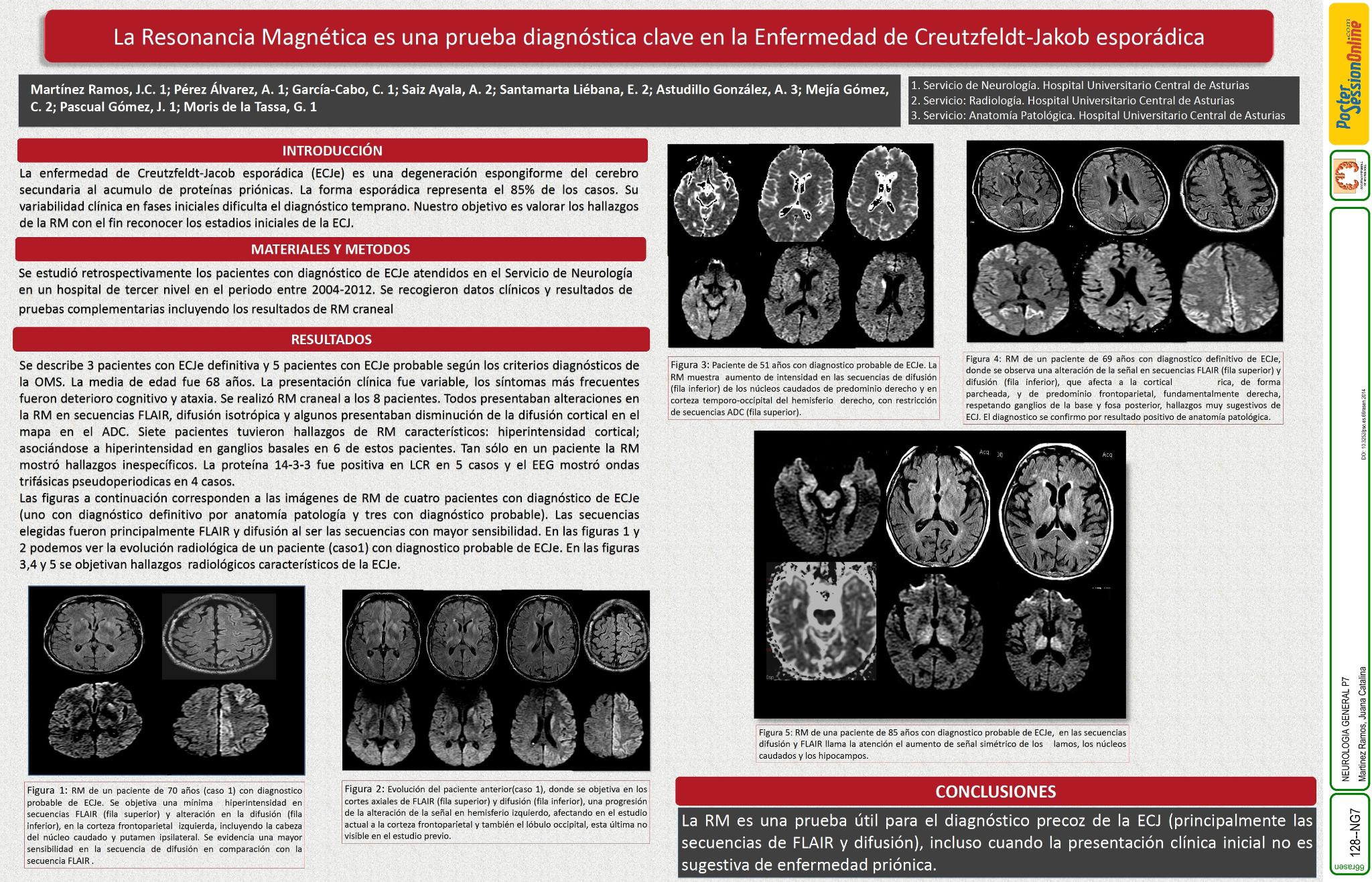 La Resonancia Magnética es una prueba diagnóstica clave en la Enfermedad de Creutzfeldt-Jakob esporádica