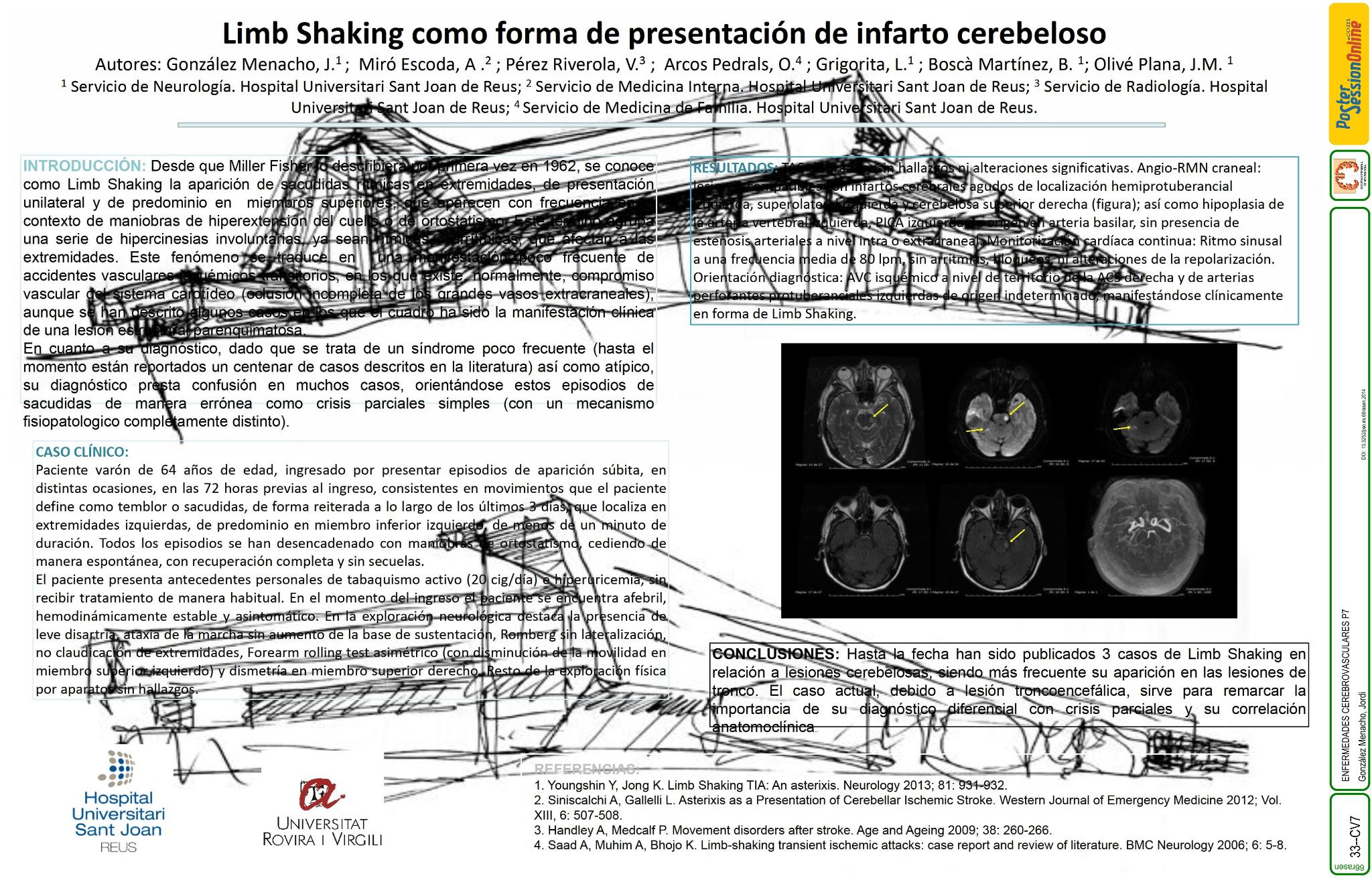 Limb shaking como forma de presentación de infarto cerebeloso