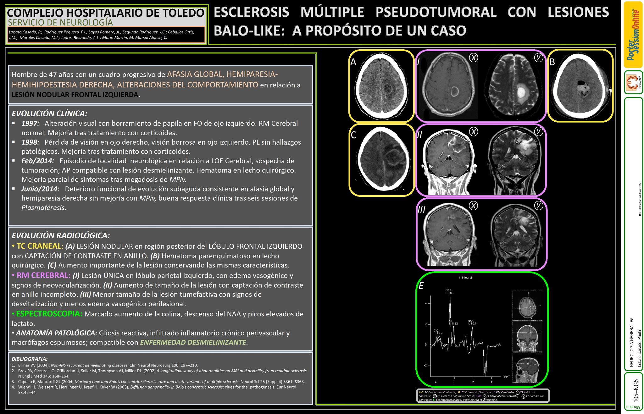 Esclerosis múltiple pseudotumoral con lesiones Balo-like: a propósito de un caso