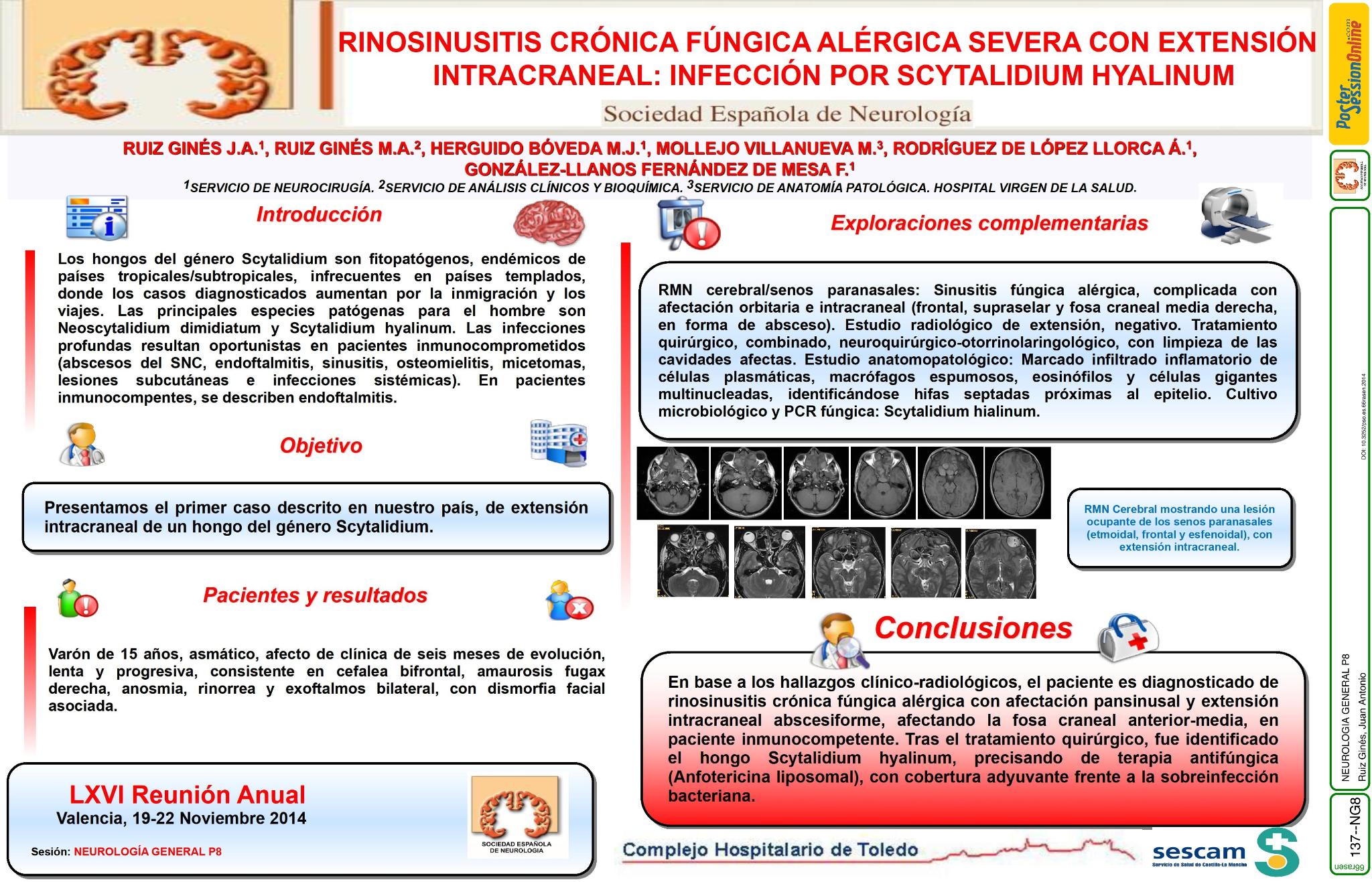 Rinosinusitis crónica fúngica alérgica severa con extensión intracraneal: Infección por Scytalidium hyalinum