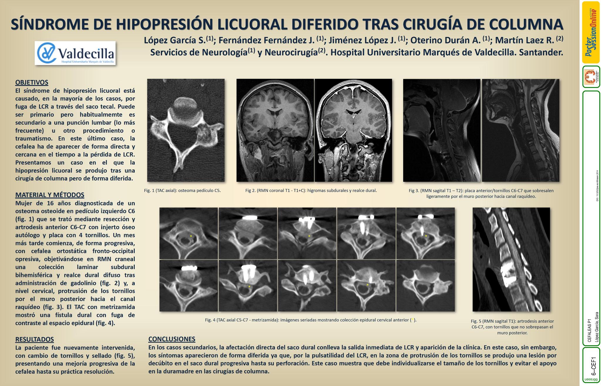 Síndrome de hipopresión licuoral diferido tras cirugía de columna