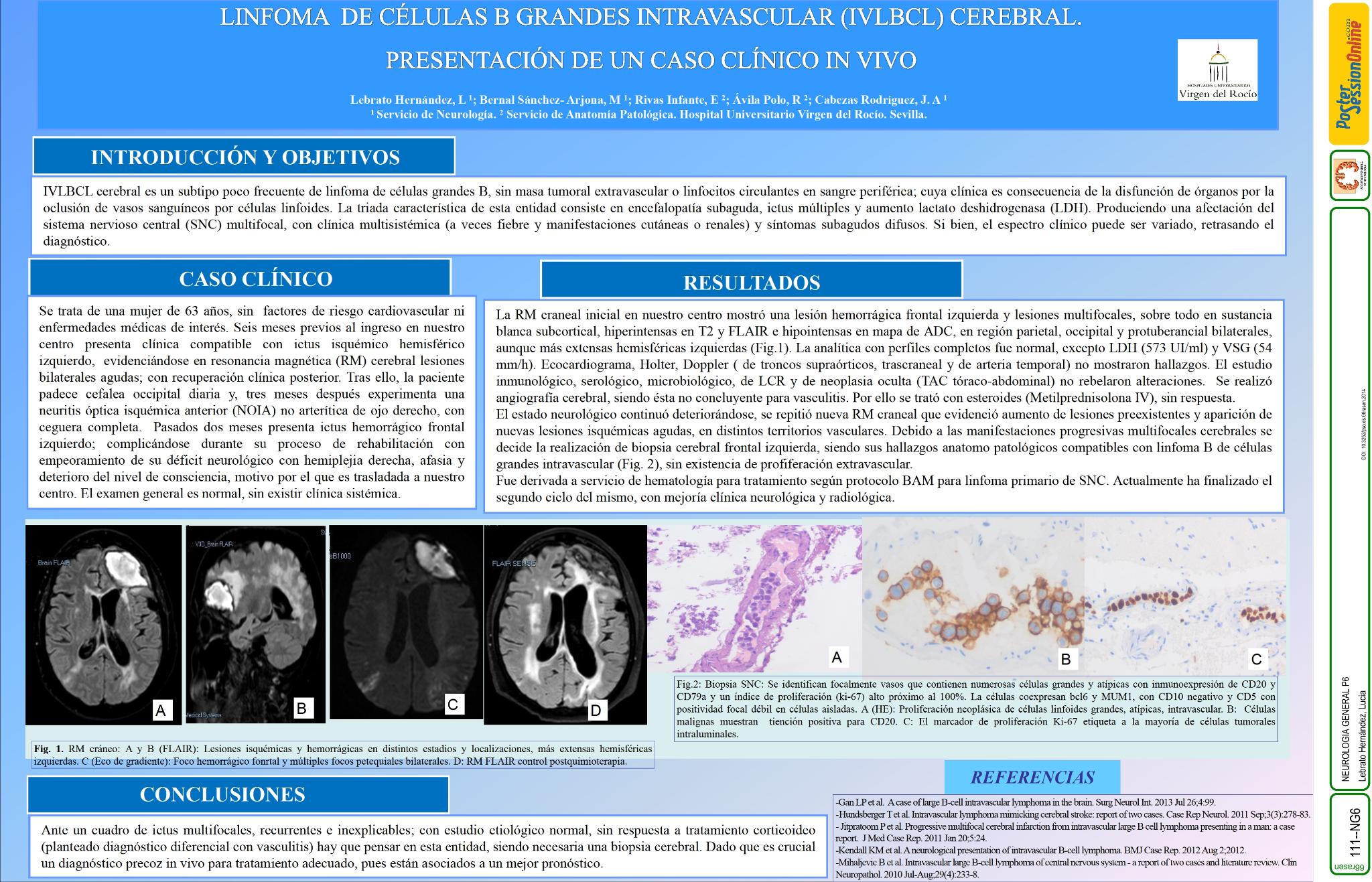 Linfoma de células B grandes intravascular cerebral. Presentación de un caso clínico