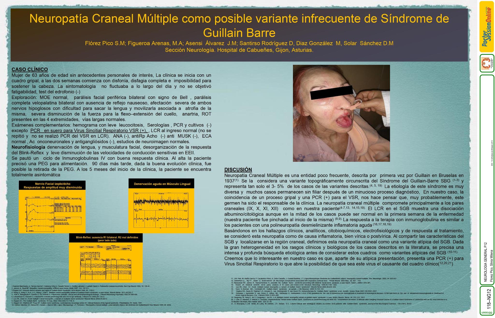 Neuropatía Craneal Múltiple como posible variante  infrecuente de Síndrome de Guillain Barre