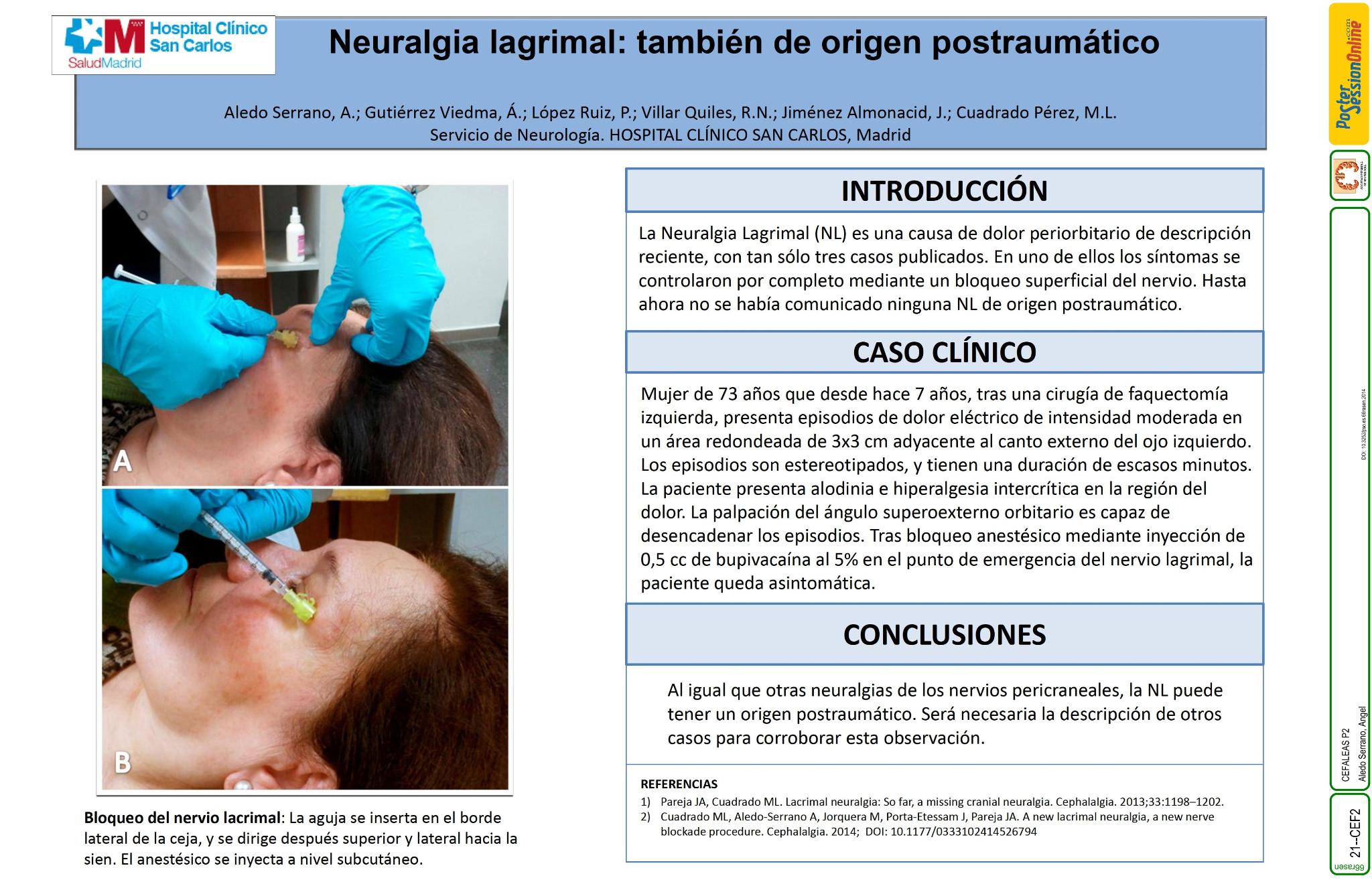 Neuralgia lagrimal: también de origen postraumático