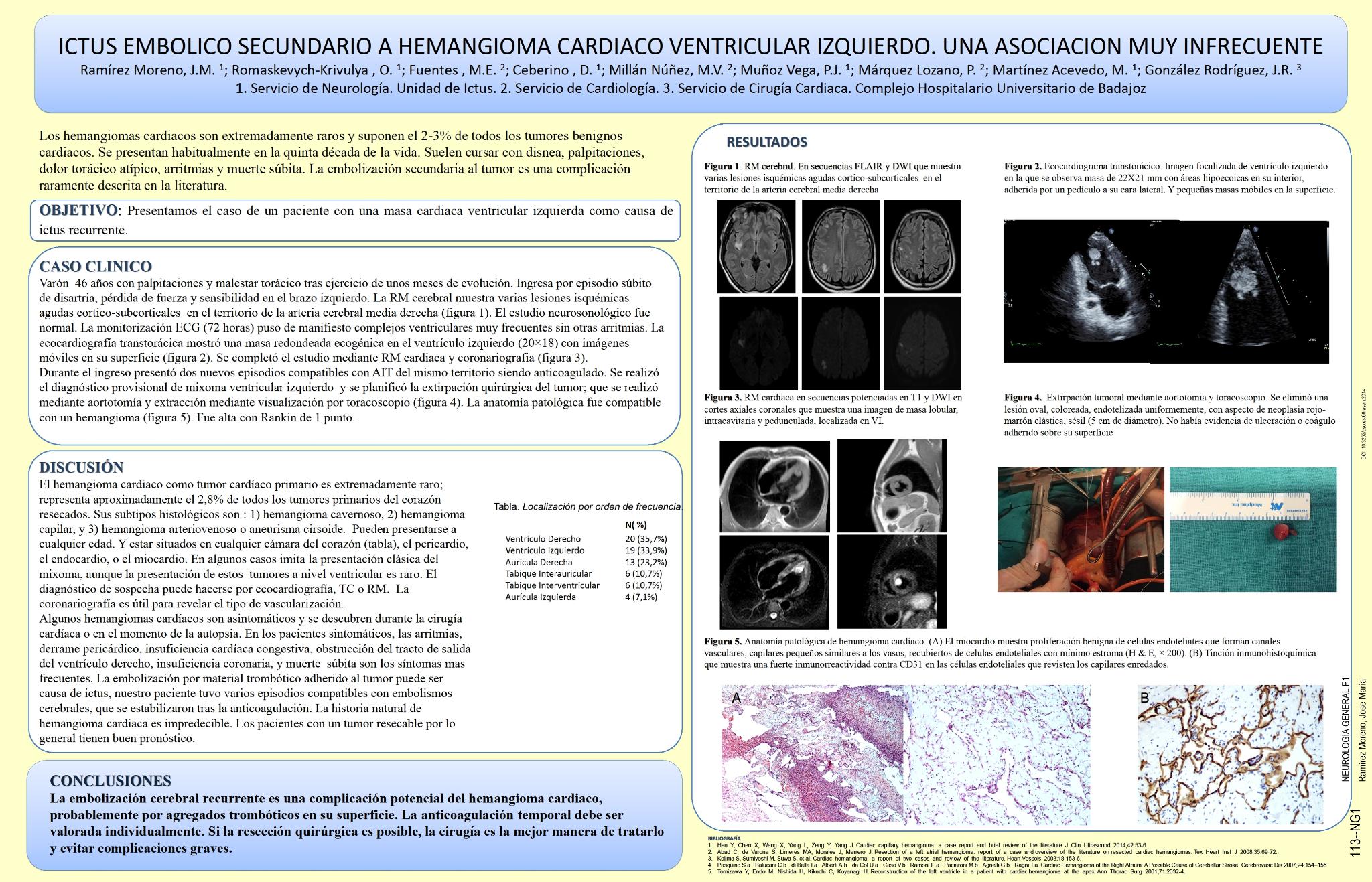 Ictus embolico secundario a hemangioma cardiaco ventricular izquierdo. Una asociacion muy infrecuente