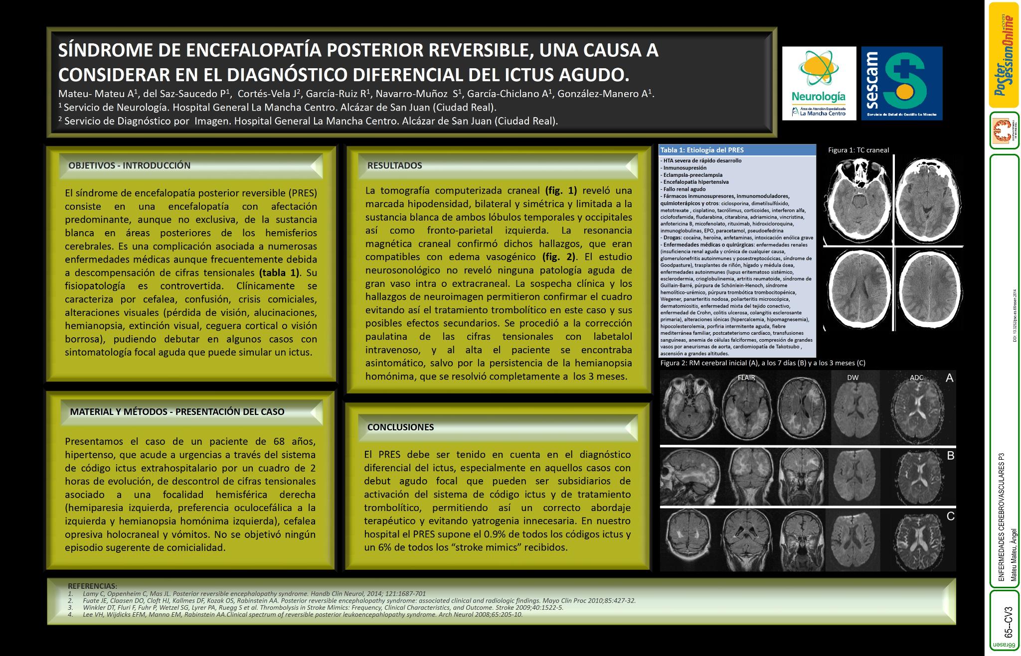 Síndrome de encefalopatía Posterior Reversible, una causa a considerar en el diagnóstico diferencial del ictus agudo