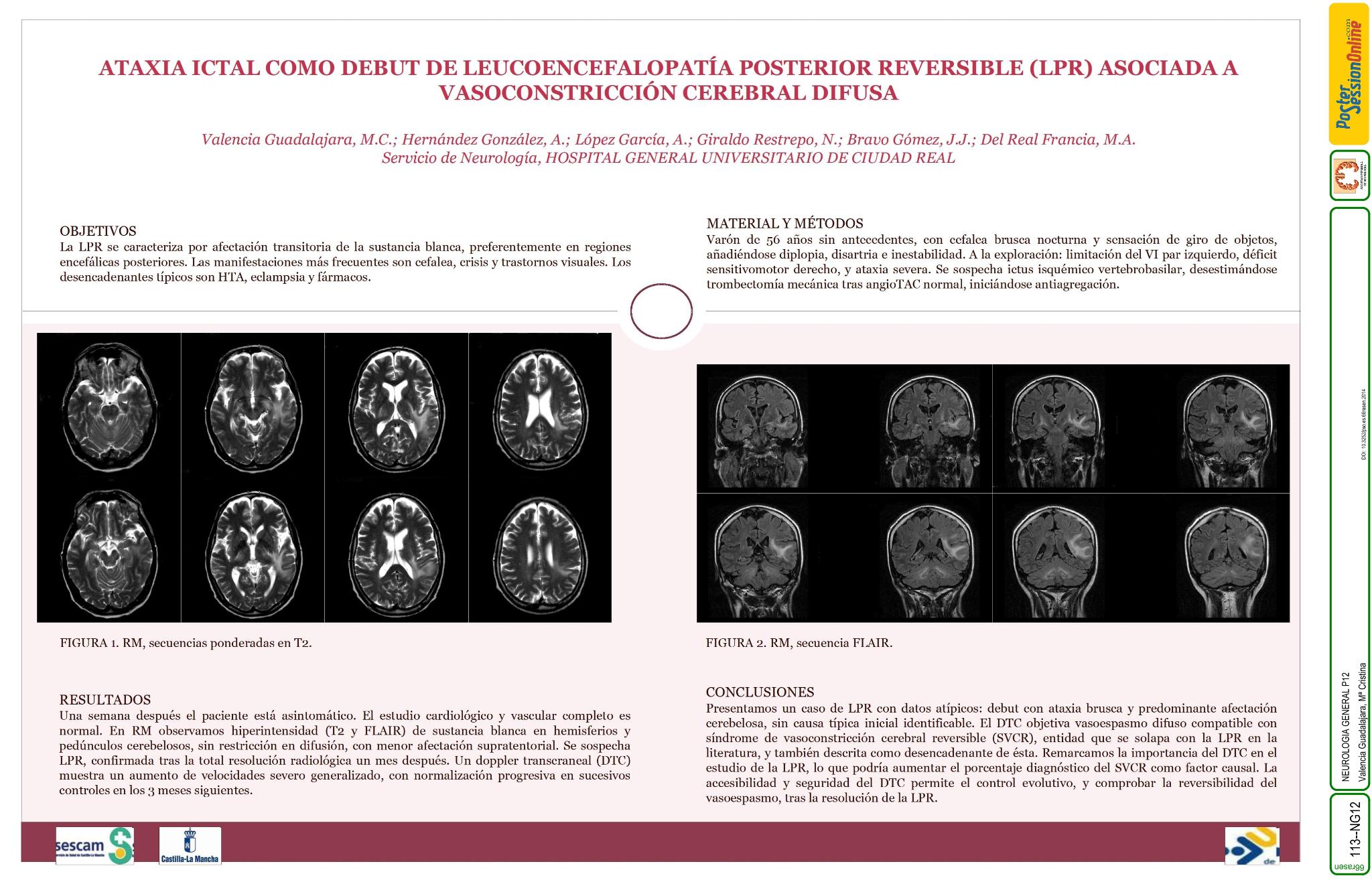 Ataxia ictal como debut de leucoencefalopatía posterior reversible (lPR) asociada a vasoconstricción cerebral difusa