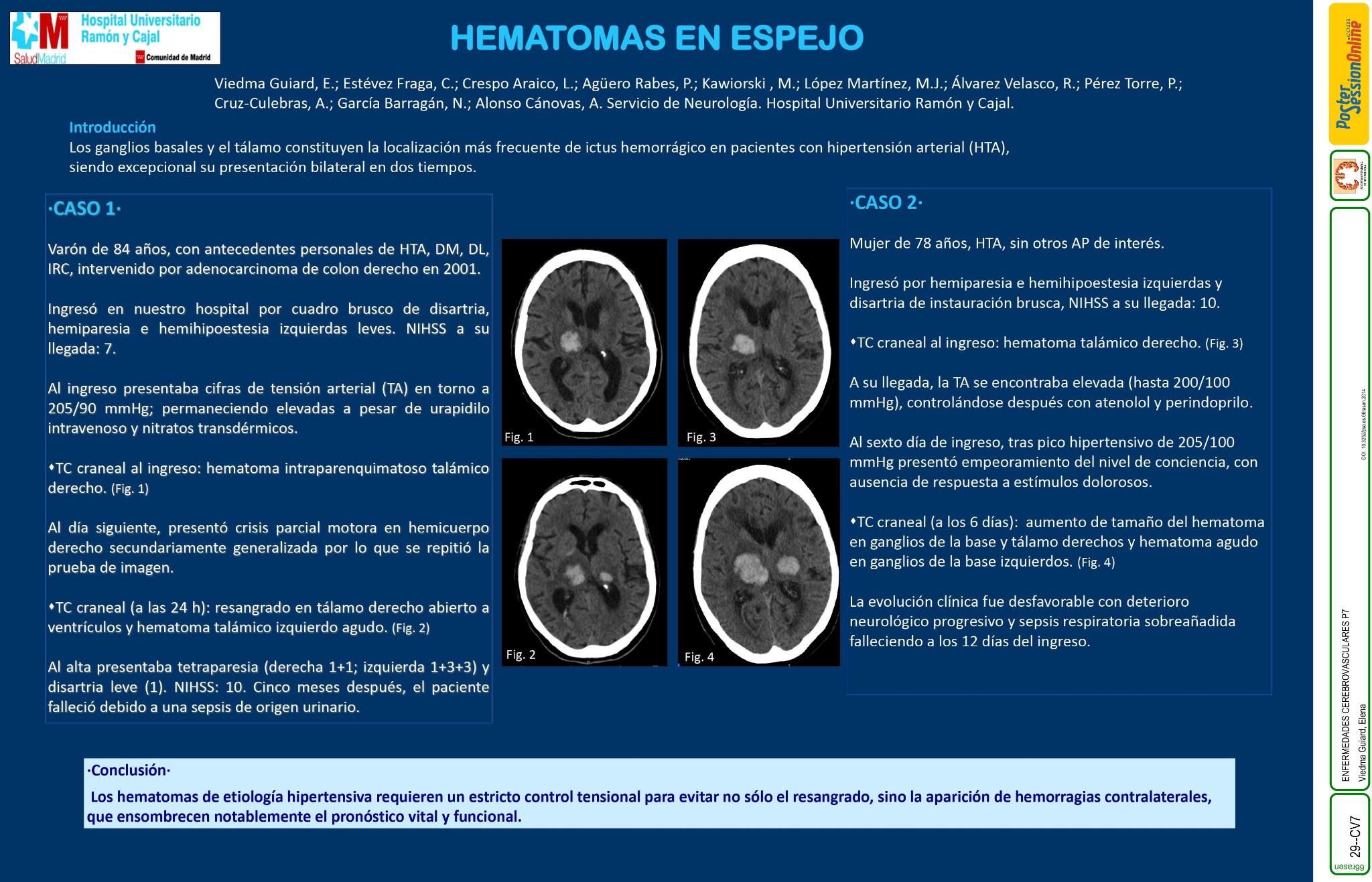 Hematomas en espejo