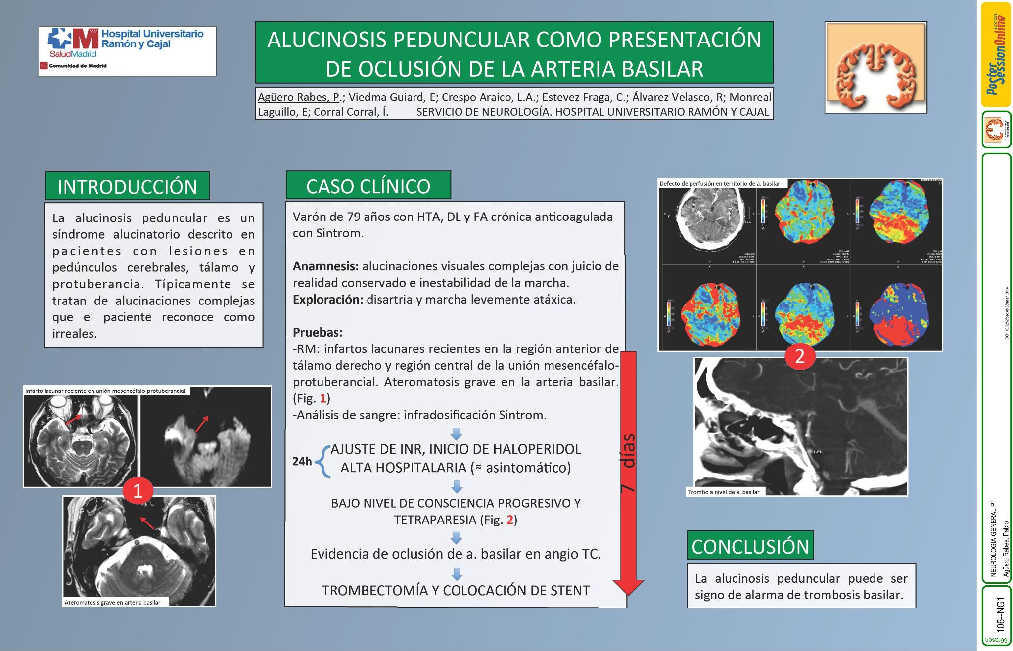 Alucinosis peduncular como presentación de oclusión de la arteria basilar