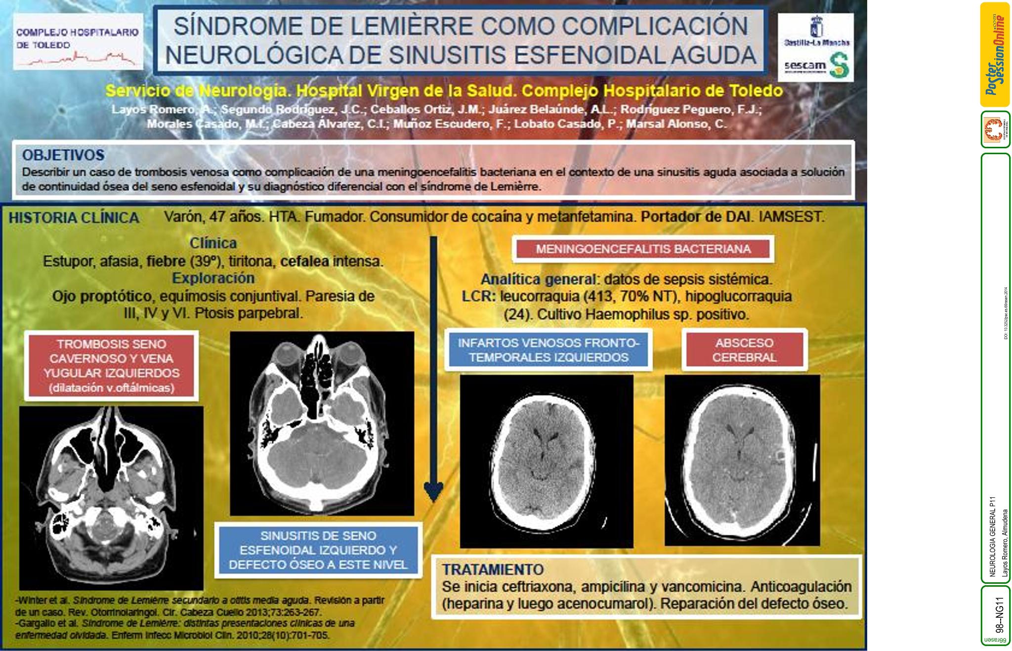 Síndrome de Lemièrre como entidad clínica a incluir en el diagnóstico diferencial de complicaciones neurológicas de origen séptico secundarias a sinusitis esfenoidal aguda. A propósito de un caso