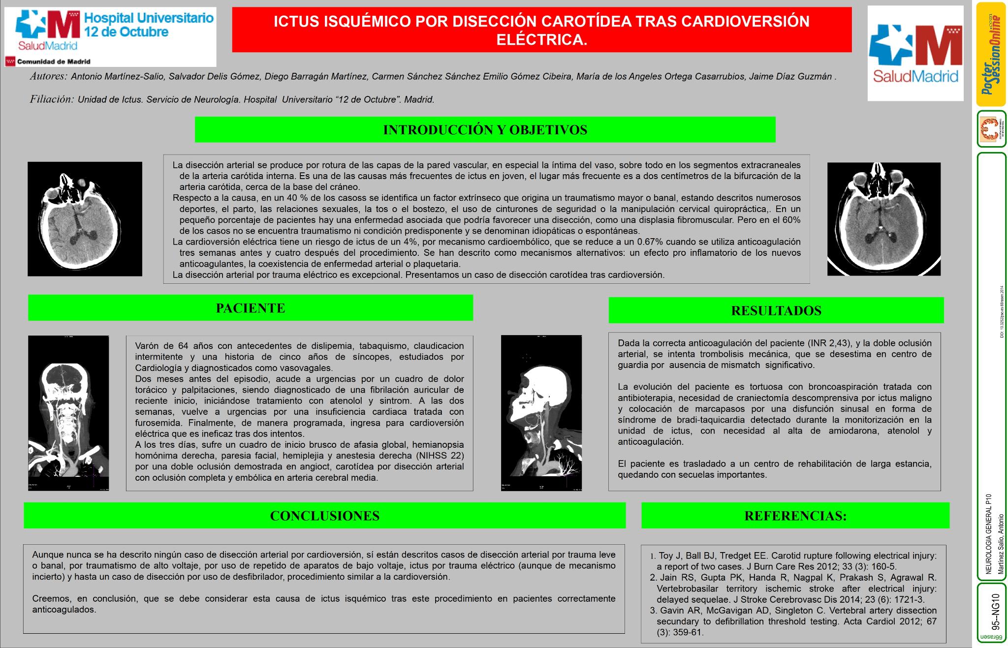 Ictus isquémico por disección carotídea tras cardioversión eléctrica