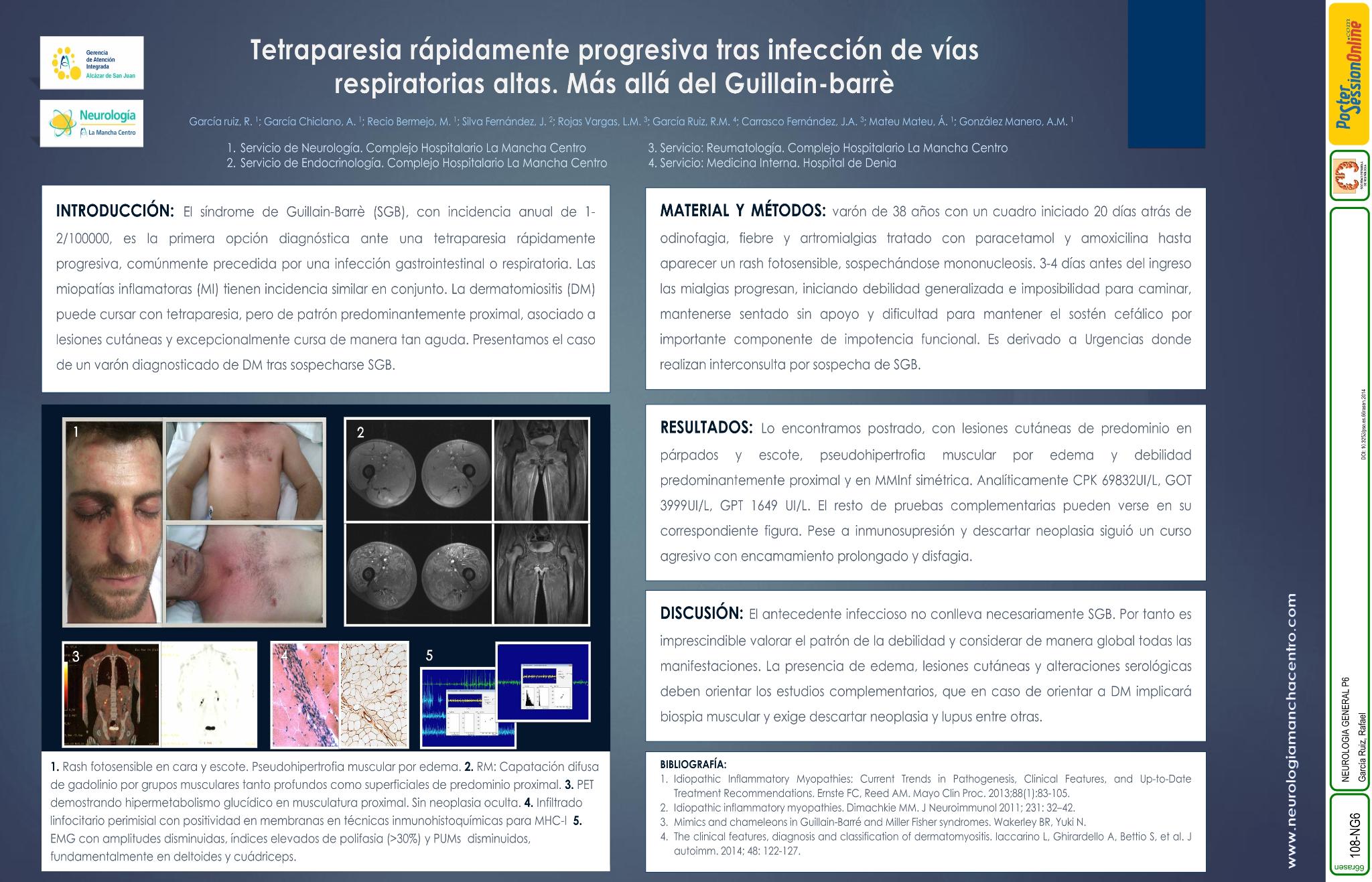 Tetraparesia rápidamente progresiva tras infección de vías respiratorias altas. Más allá del Guillain-barrè