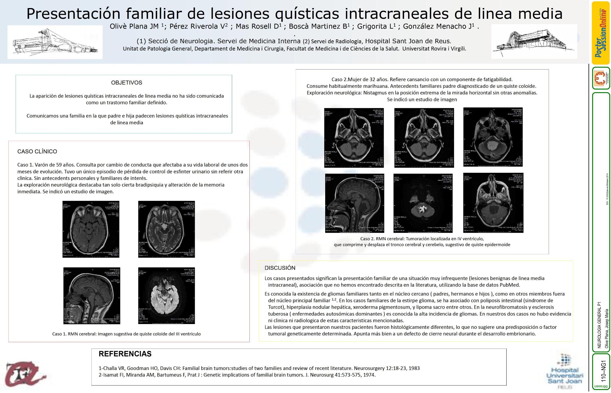 Presentación familiar de lesiones quísticas intracraneales de línea media