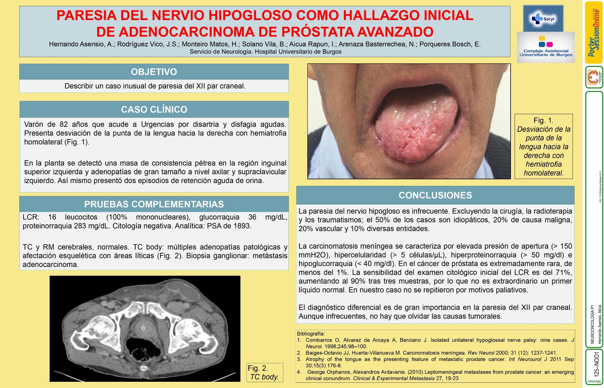 Paresia del nervio hipogloso como hallazgo inicial de adenocarcinoma de próstata avanzado