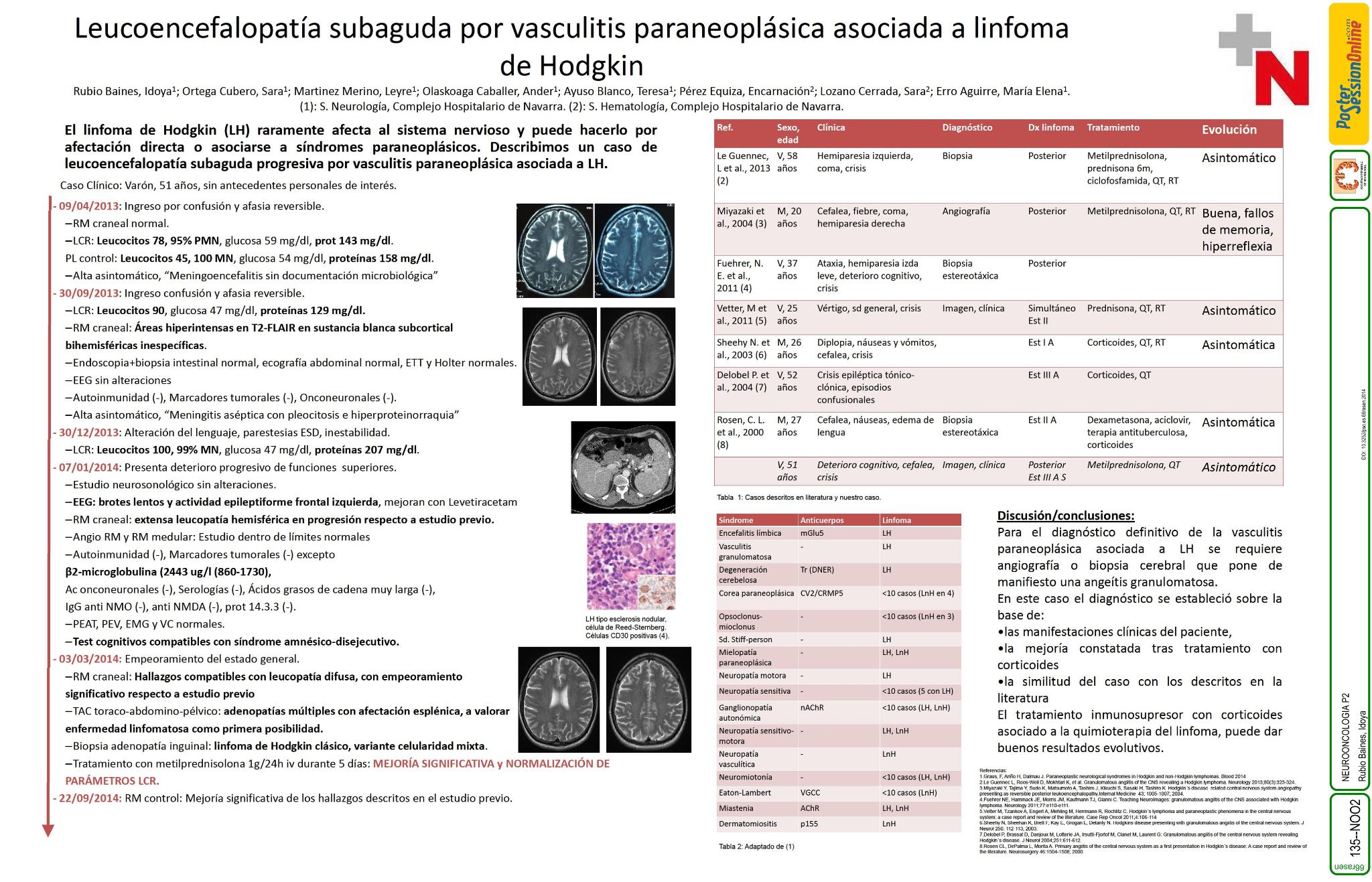 Leucoencefalopatía subaguda por vasculitis paraneoplásica asociada a linfoma de Hodgkin