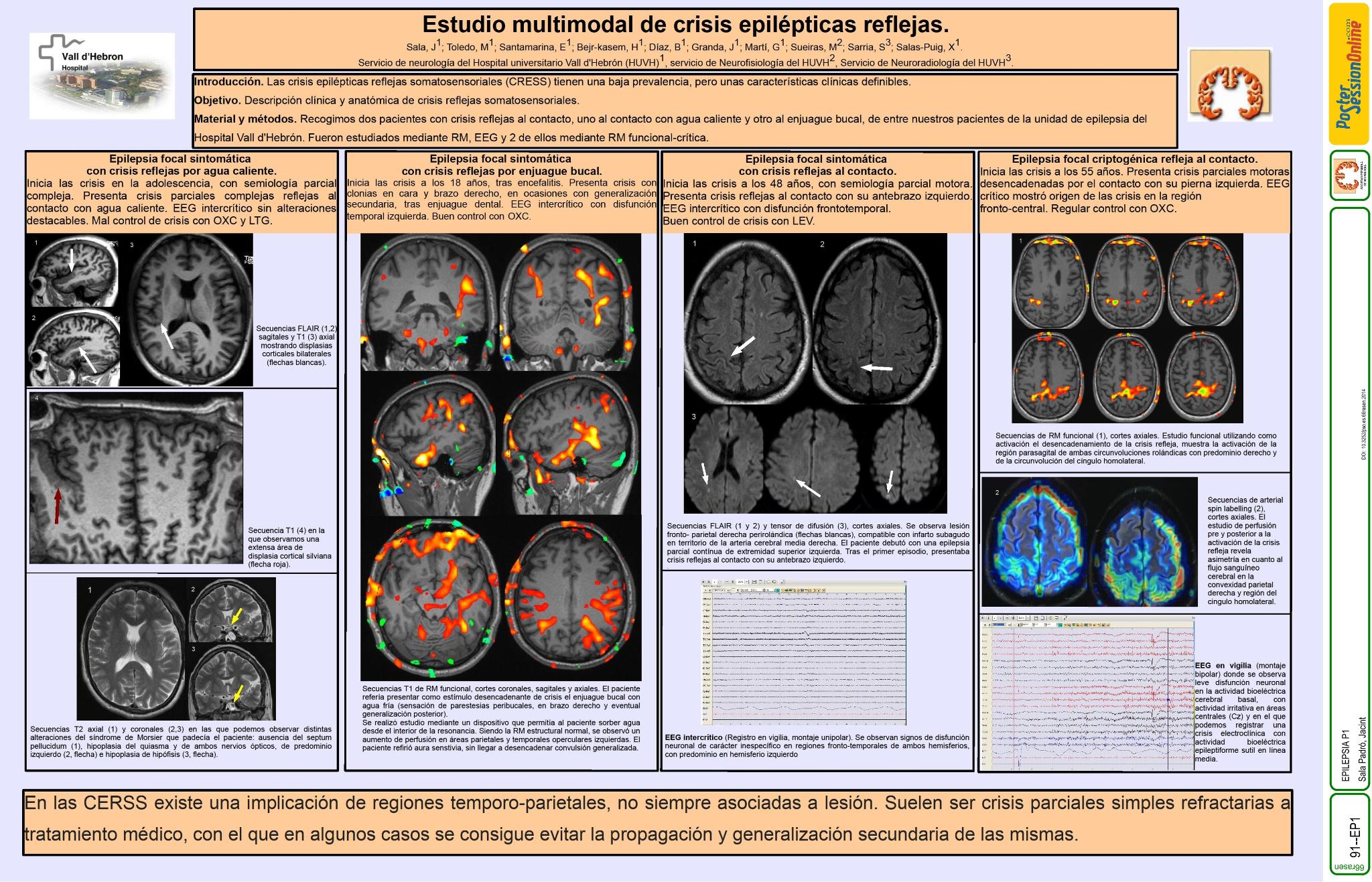 Estudio multimodal de crisis epilépticas reflejas a estímulos somatosensoriales