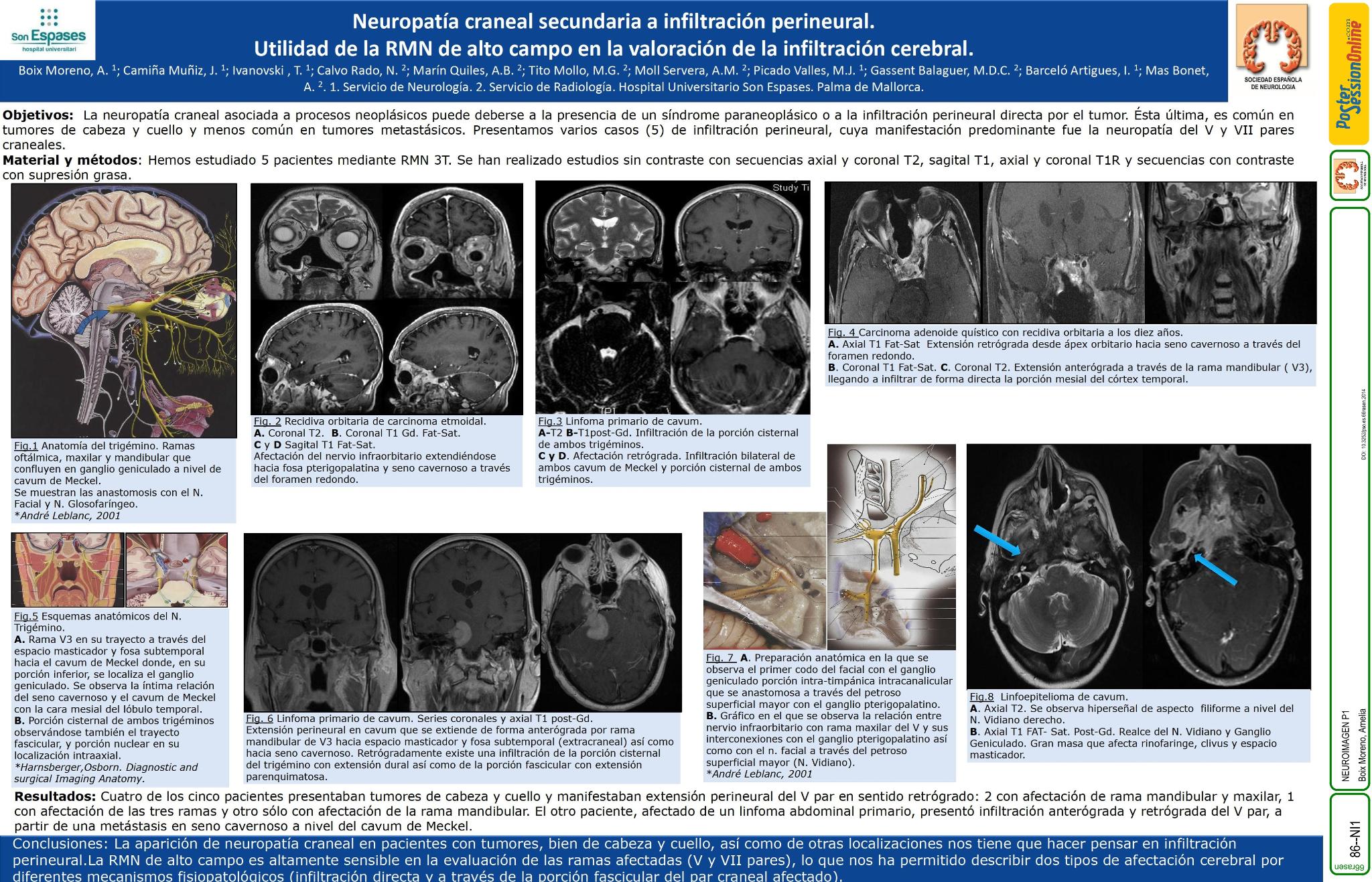 Neuropatía craneal secundaria a infiltración perineural. Utilidad de la RMN de alto campo en la valoración de la infiltración cerebral