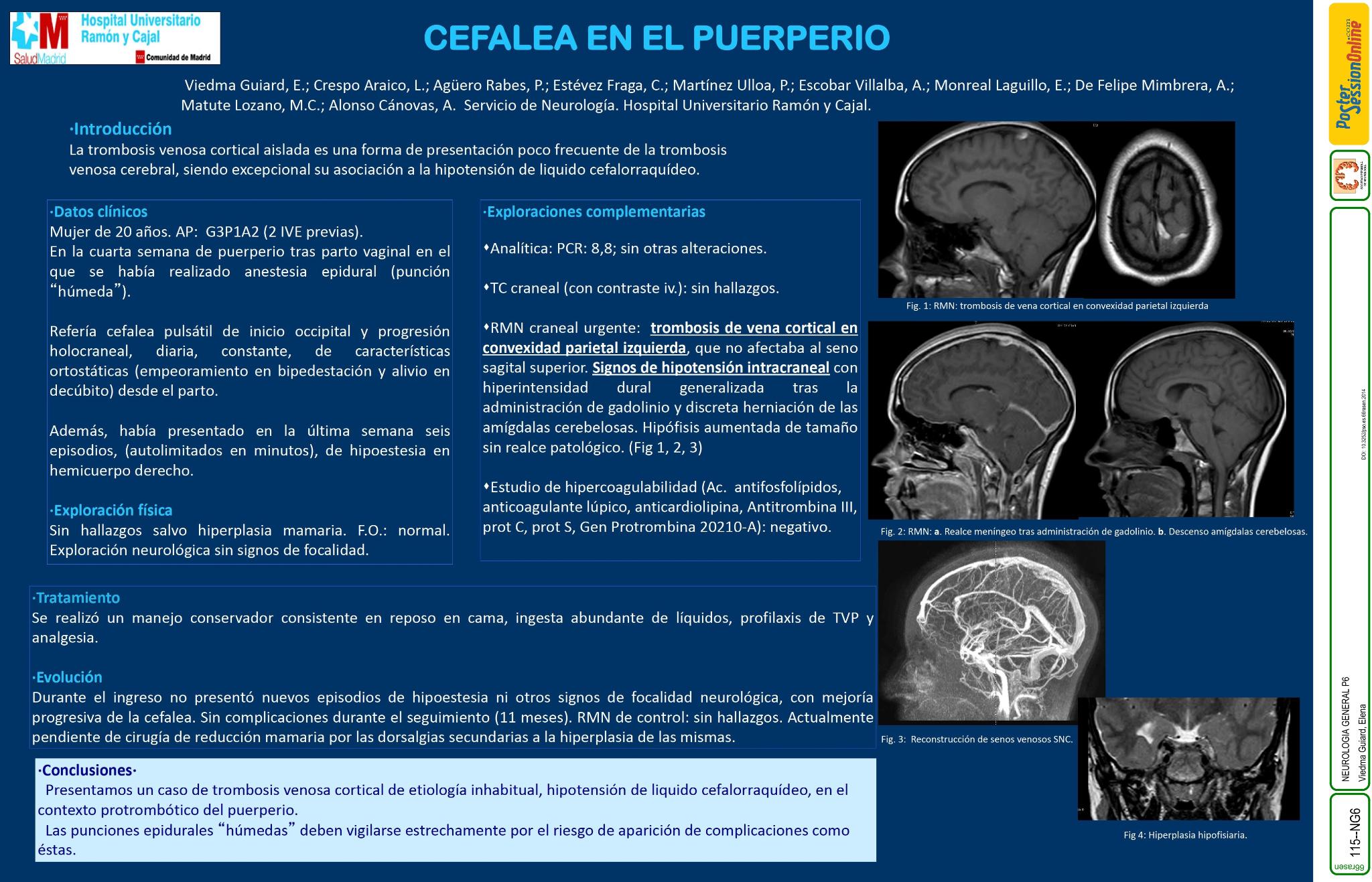 Cefalea en el puerperio