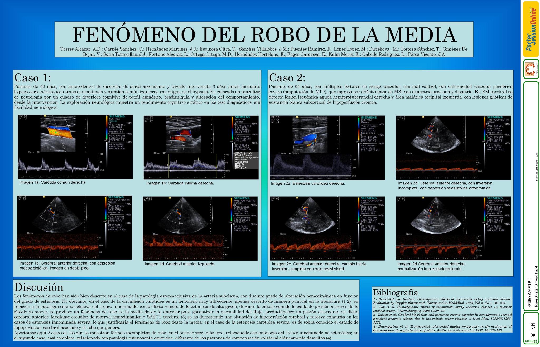 Un nuevo patrón hemodinámico intracraneal: "El Robo de la Media"