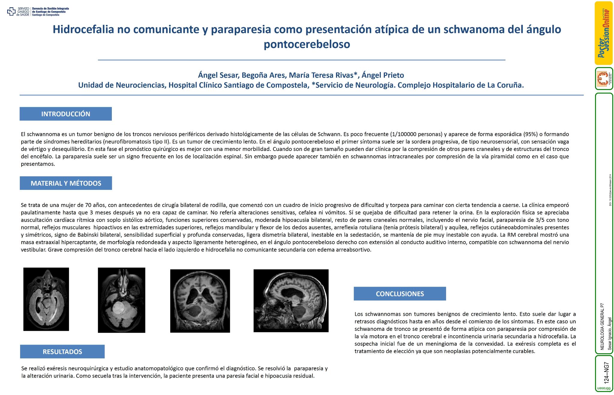 Hidrocefalia no comunicante y paraparesia como presentación atípica de schwannoma