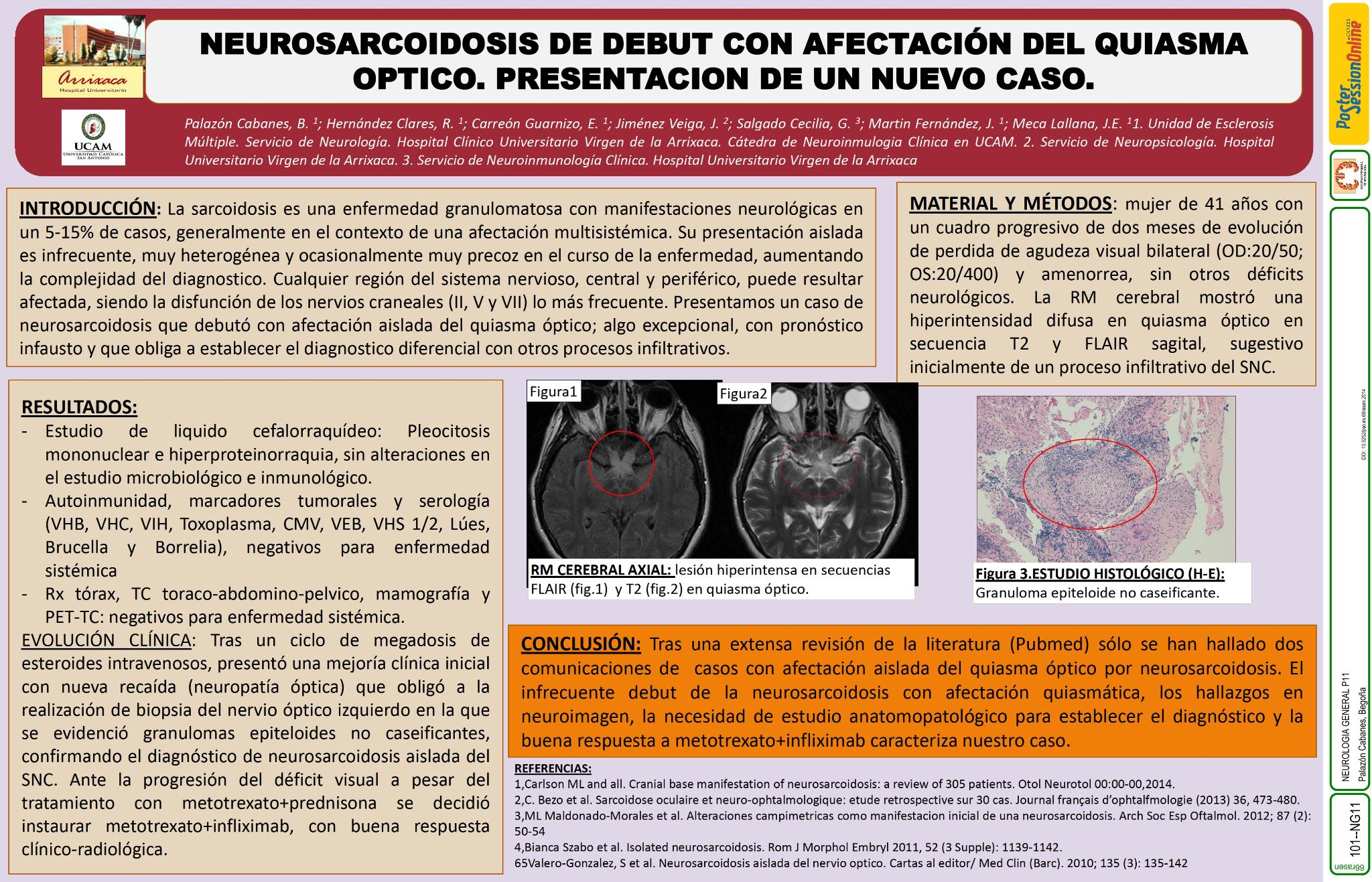 Neurosarcoidosis de debut con afectación del quiasma óptico. Presentación de un nuevo caso