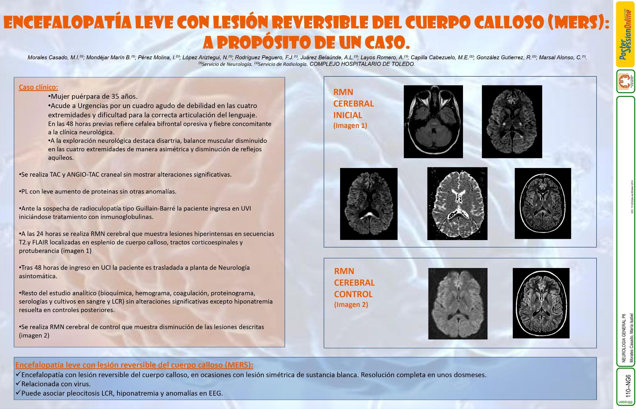 Encefalopatía leve con lesión reversible del esplenio del cuerpo calloso (MERS). A propósito de un caso